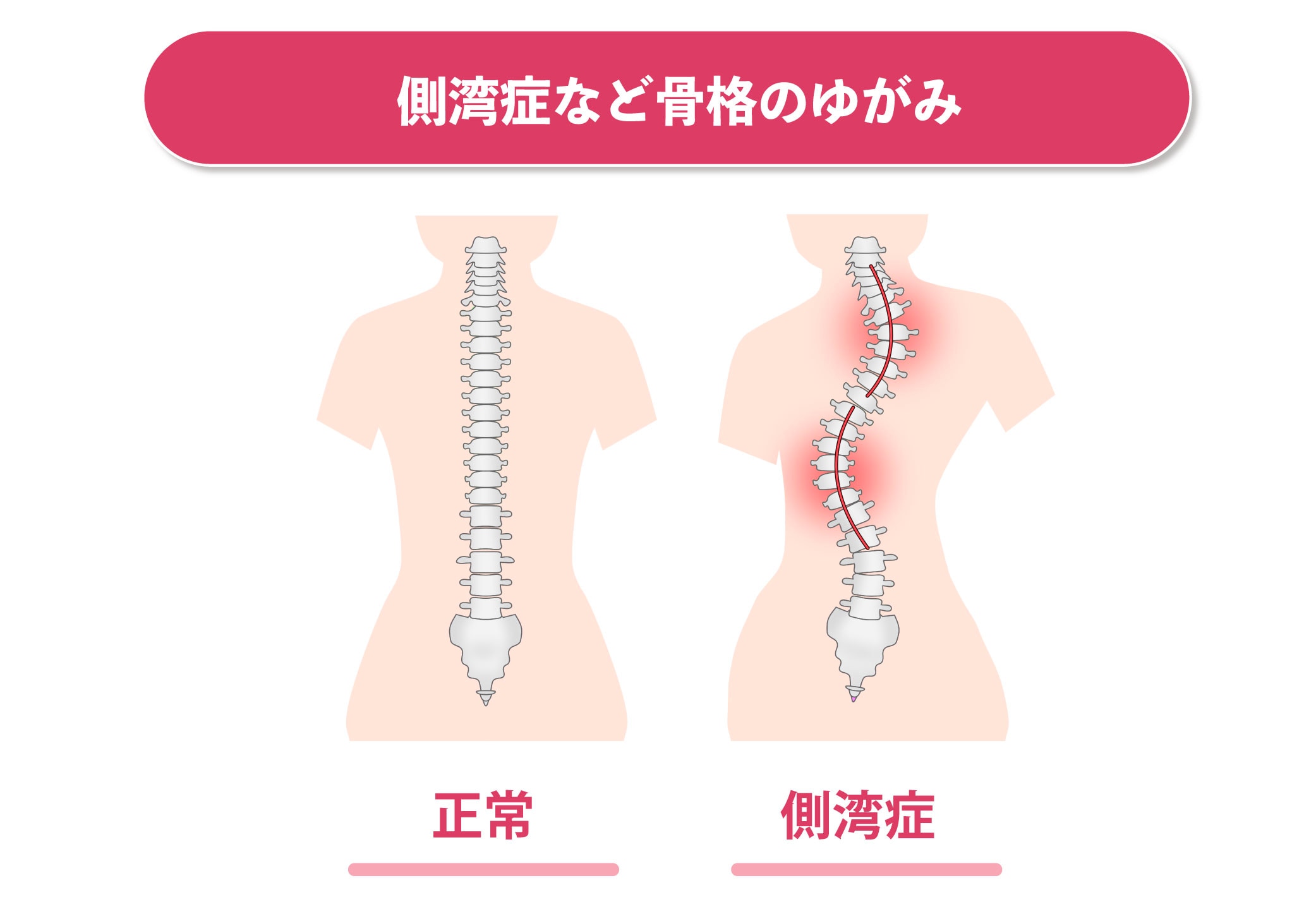 左右 胸 の 大き さ が 違う