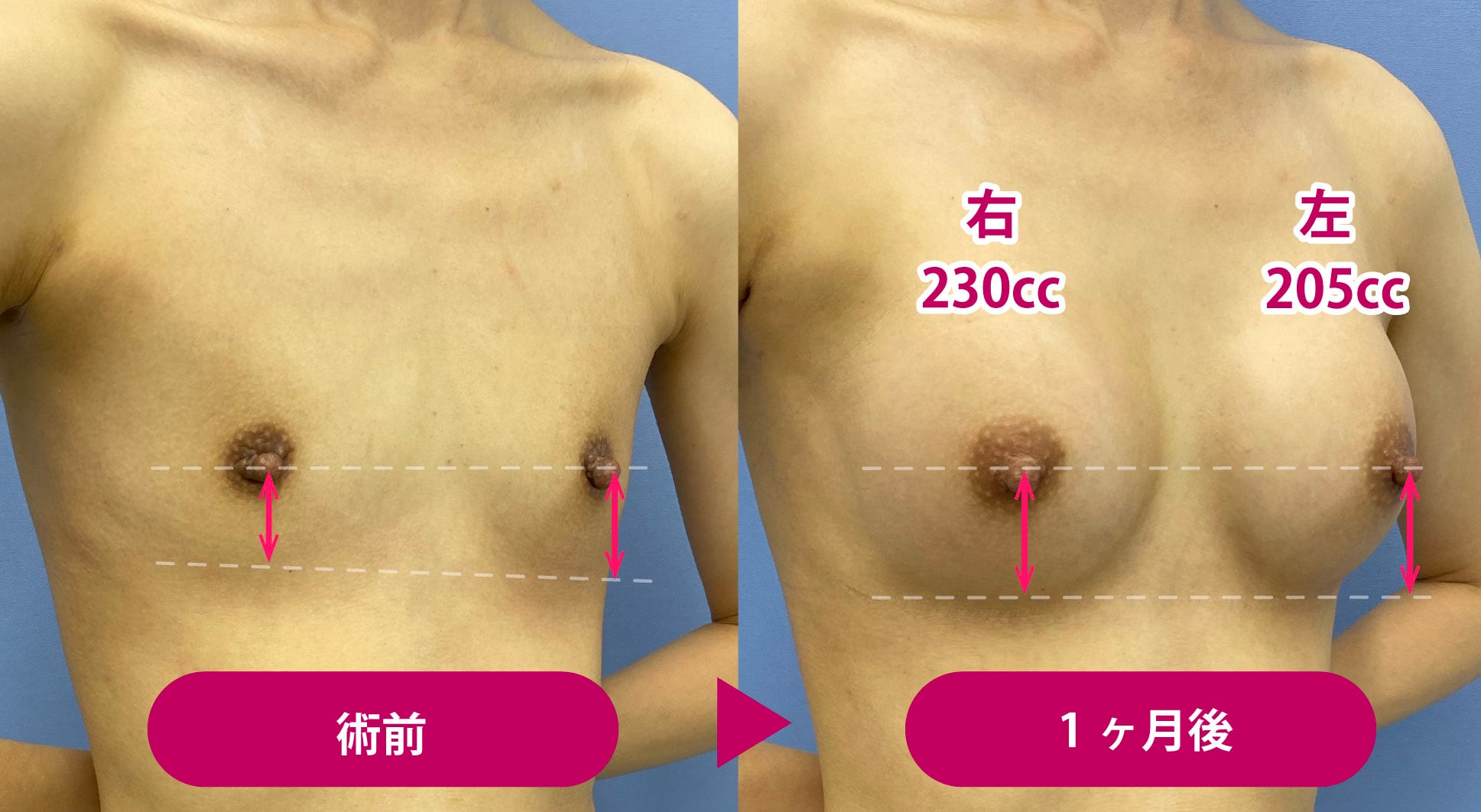 胸 左右 大き さ 違う