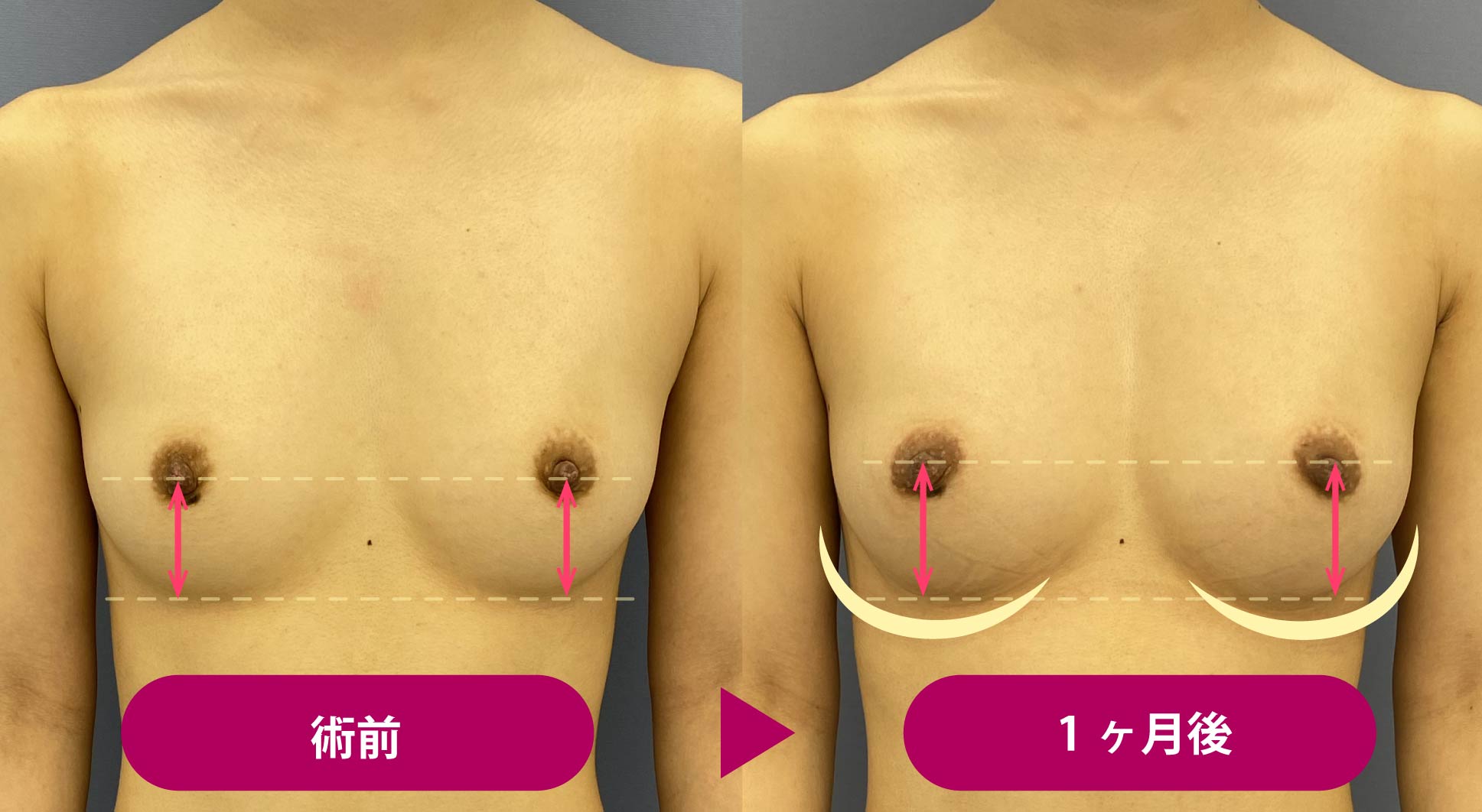 美乳房 バージスラインとは？胸のラインをくっきり出すには豊胸手術がおすすめ！ - 銀座院