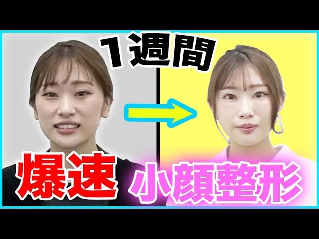 小顔整形後の1週間の経過！ダウンタイムのリアルな感想を紹介！