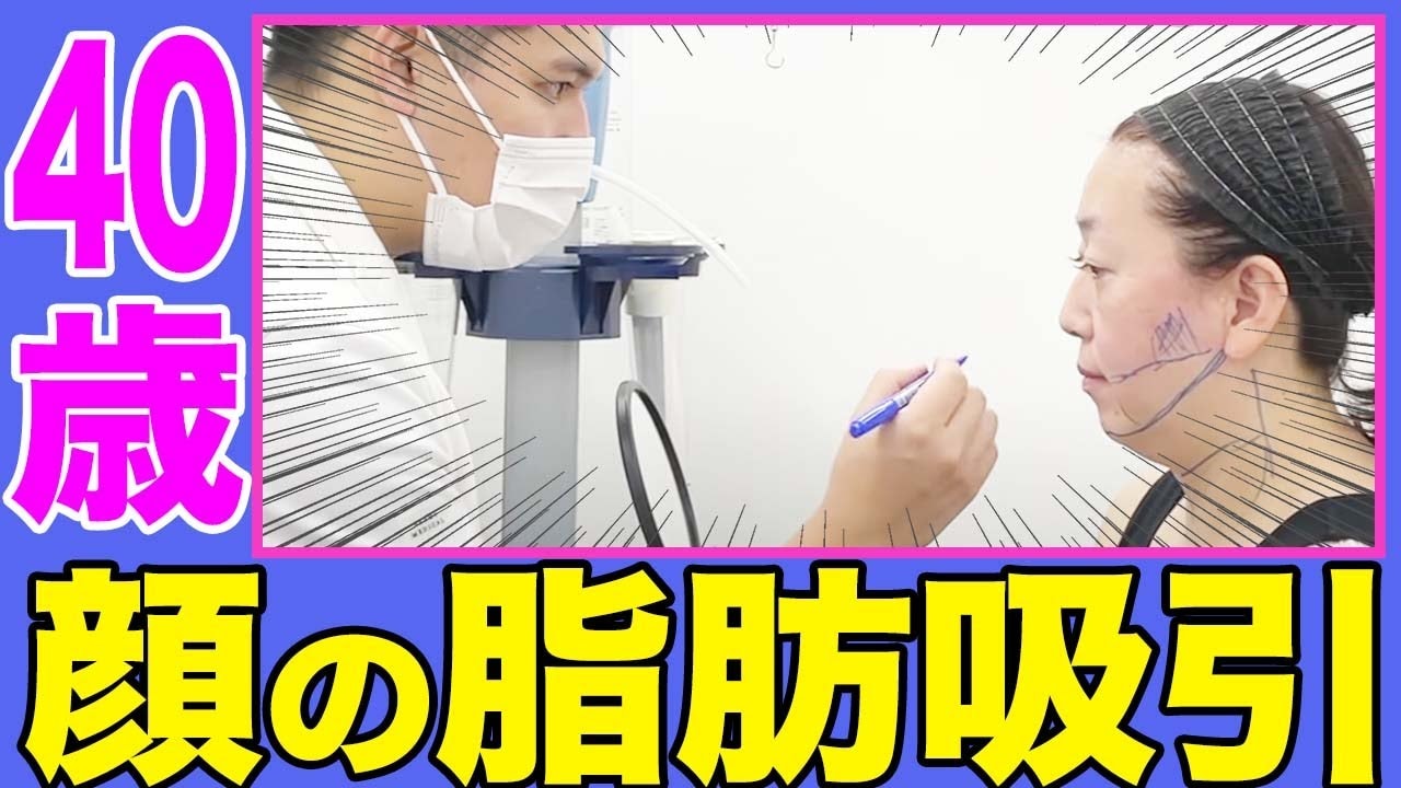 顔の脂肪吸引1ヶ月後の経過！40代のダウンタイムを紹介！