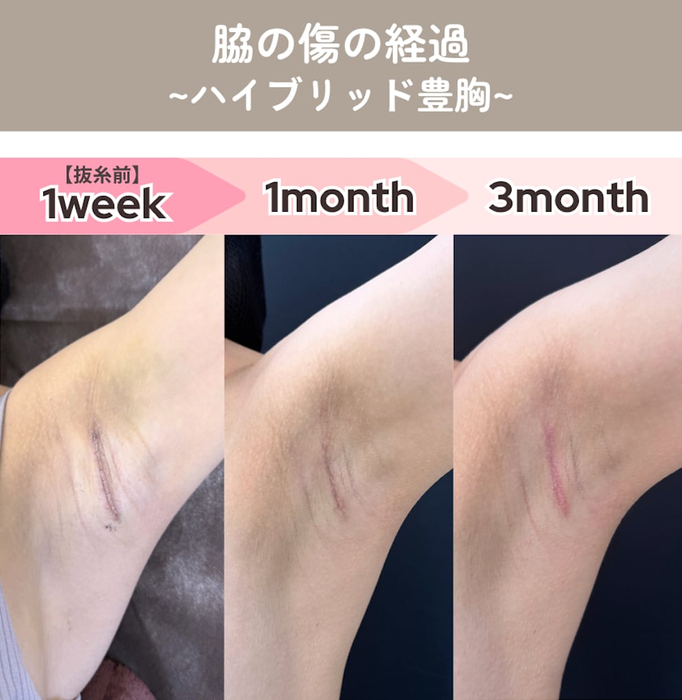 ハイブリッド豊胸の場合