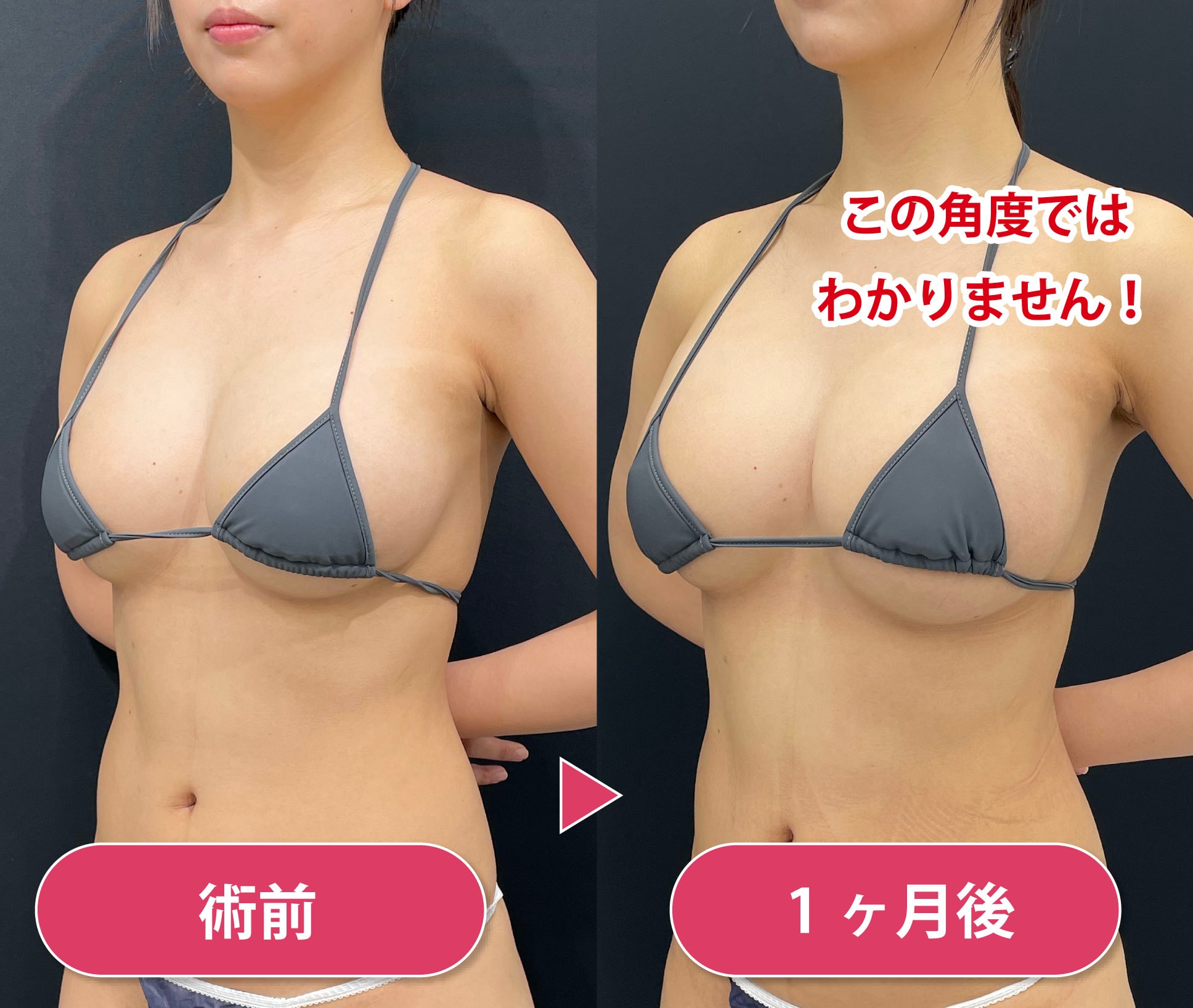 脂肪注入豊胸手術症例1