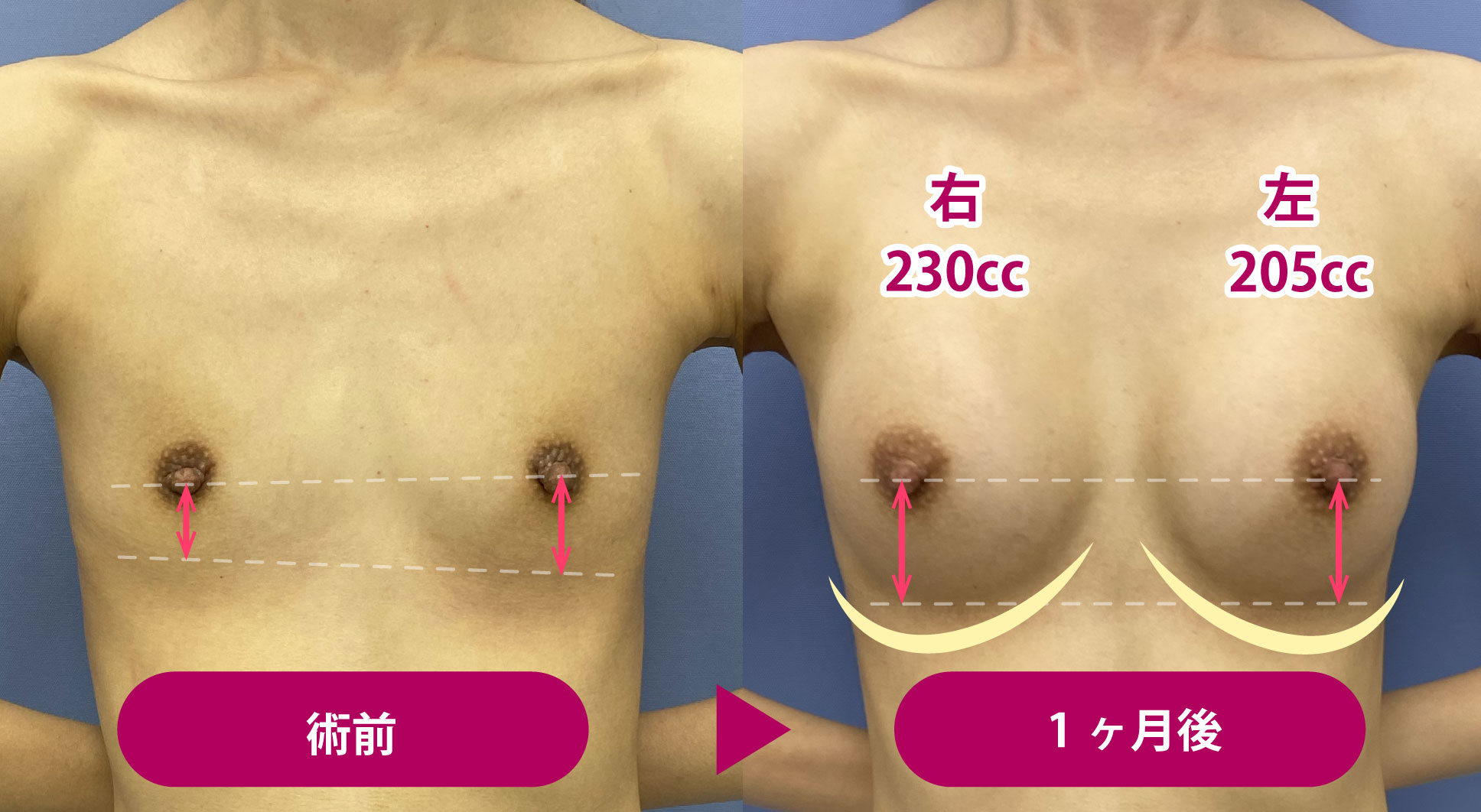 バッグのサイズを微調整！こだわりのシリコンバッグ豊胸症例