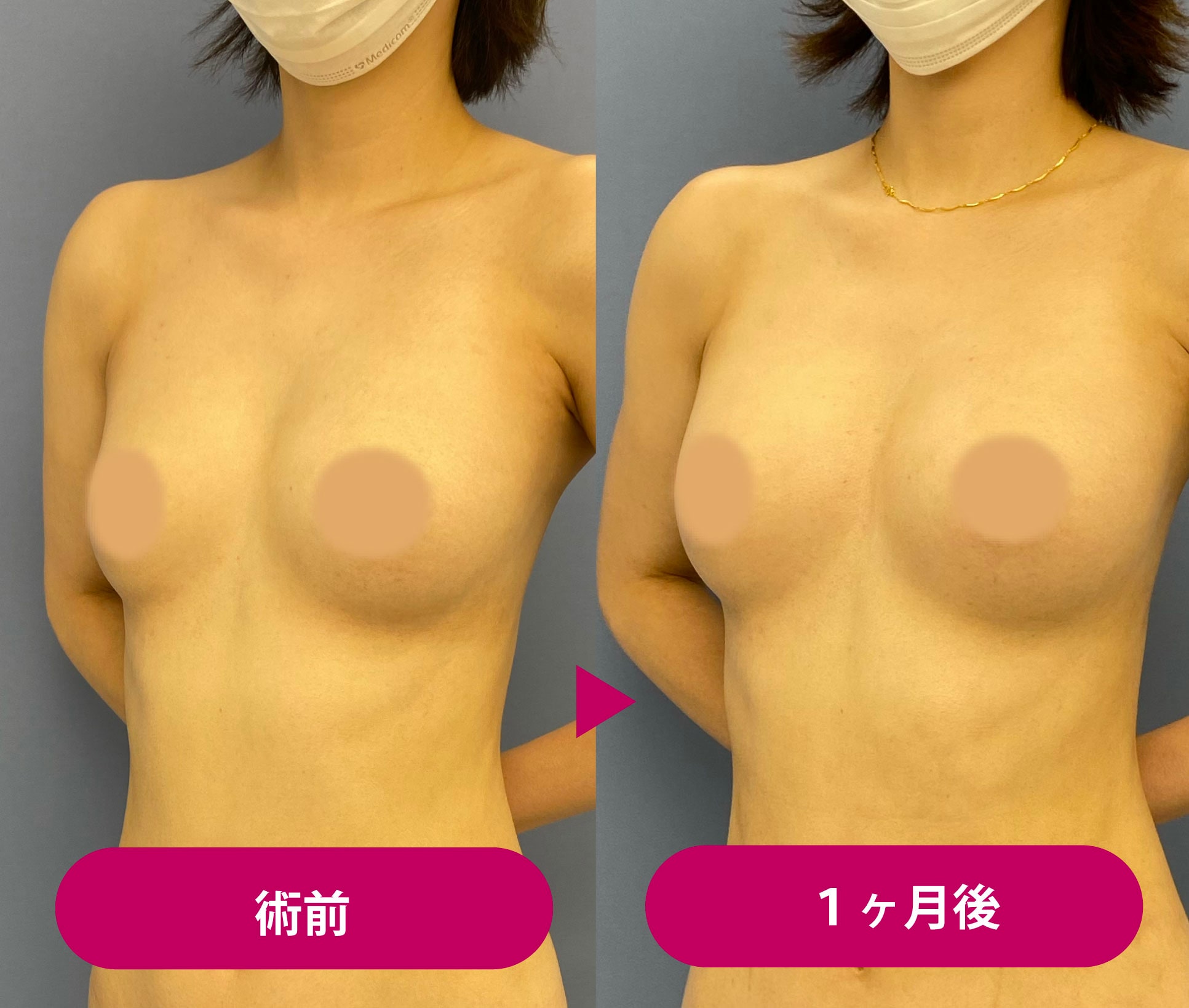 脂肪 注入 豊 胸 失敗