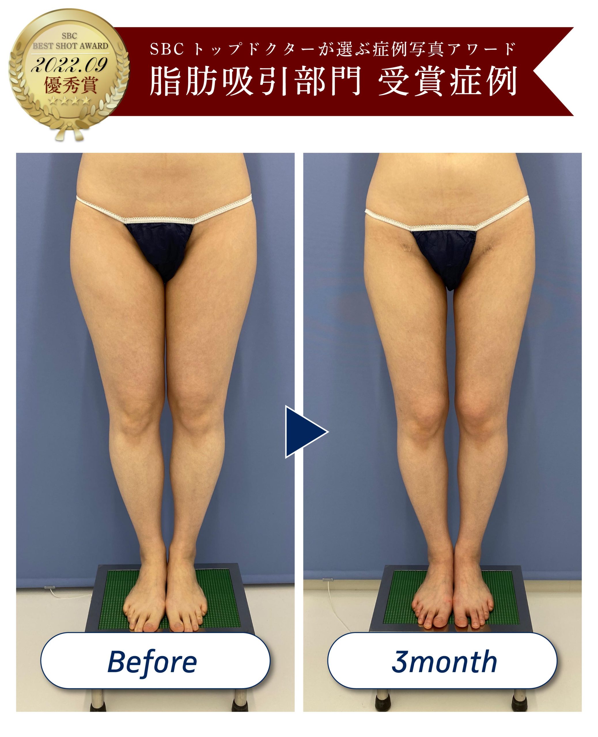 新品アミュレット 二の腕 ボレロ SSサイズ 湘南 SBC SBC湘南美容外科 アミュレット ボレロ SSサイズ 湘南美容外科 アミュレット SSS