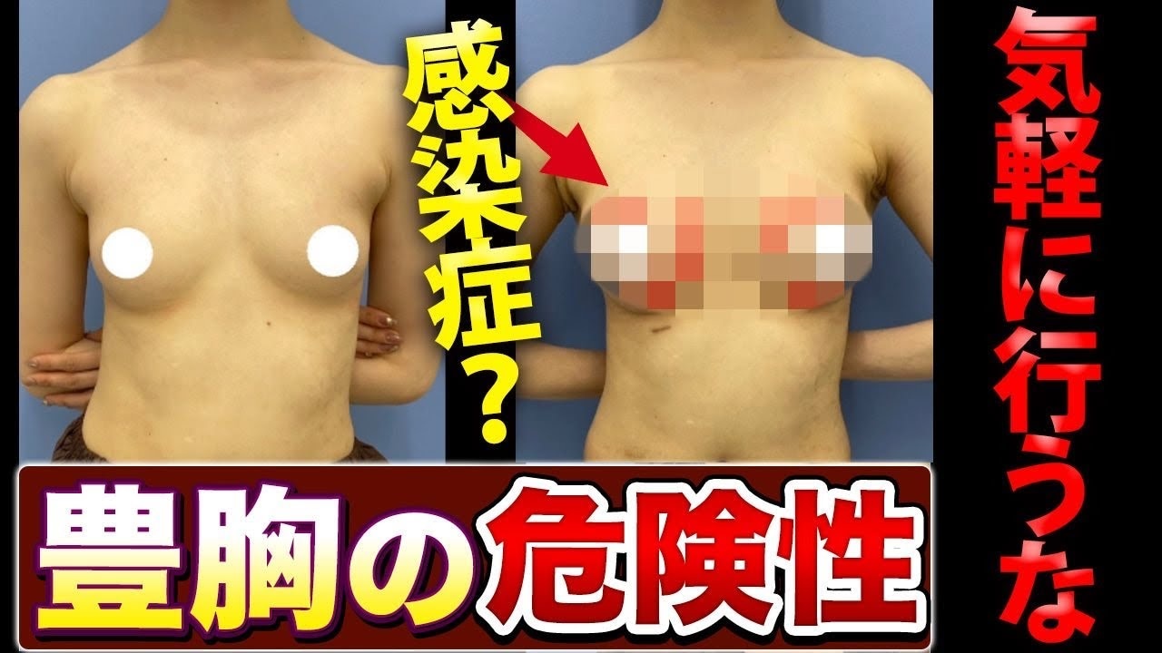 豊胸はやめたほうがいい？手術による感染症などのリスクを解説！