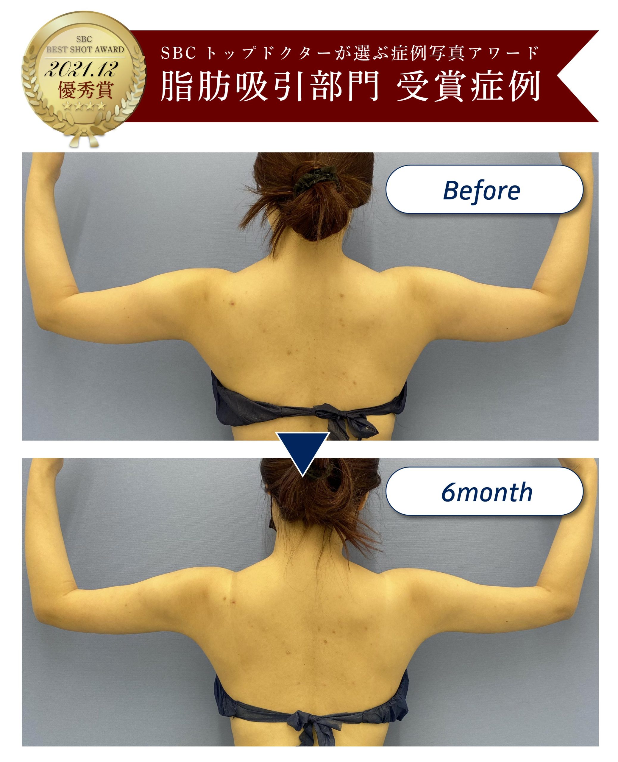アワード受賞症例写真2-二の腕・肩全周・肩甲骨横脂肪吸引