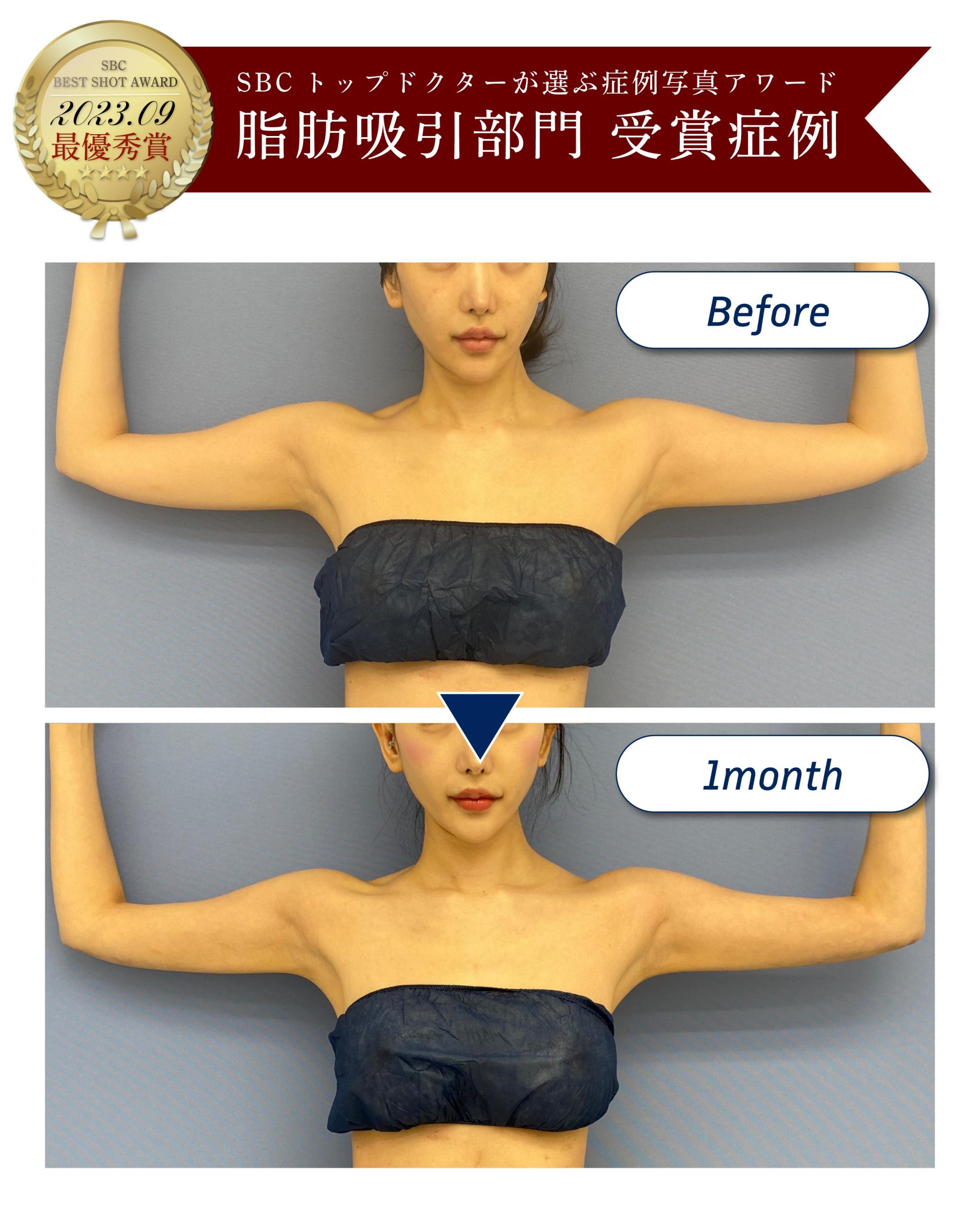 アワード受賞症例写真7-二の腕・肩・肩甲骨横脂肪吸引