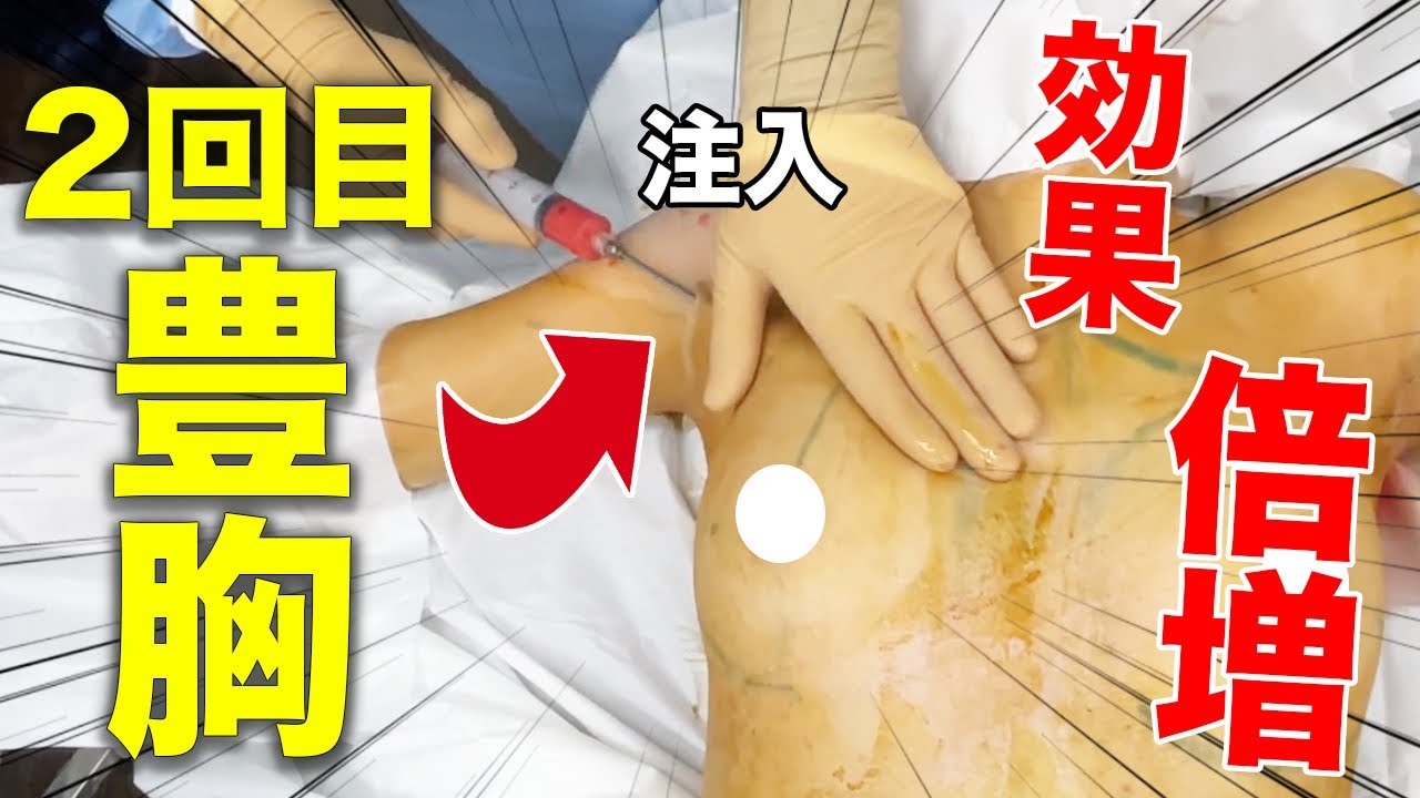 脂肪注入豊胸ダウンタイム1ヶ月目！2回目だと経過が異なるのか解説！