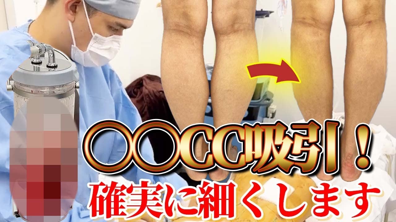 ふくらはぎの脂肪吸引とボトックスの併用！筋肉質でもやせる方法！