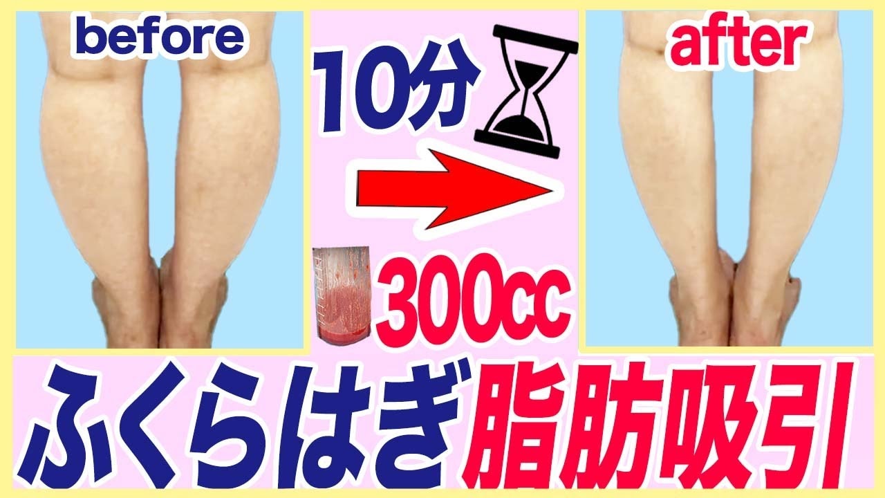 ふくらはぎの脂肪吸引は変わらないって本当？取れる量や手術時間を公開！