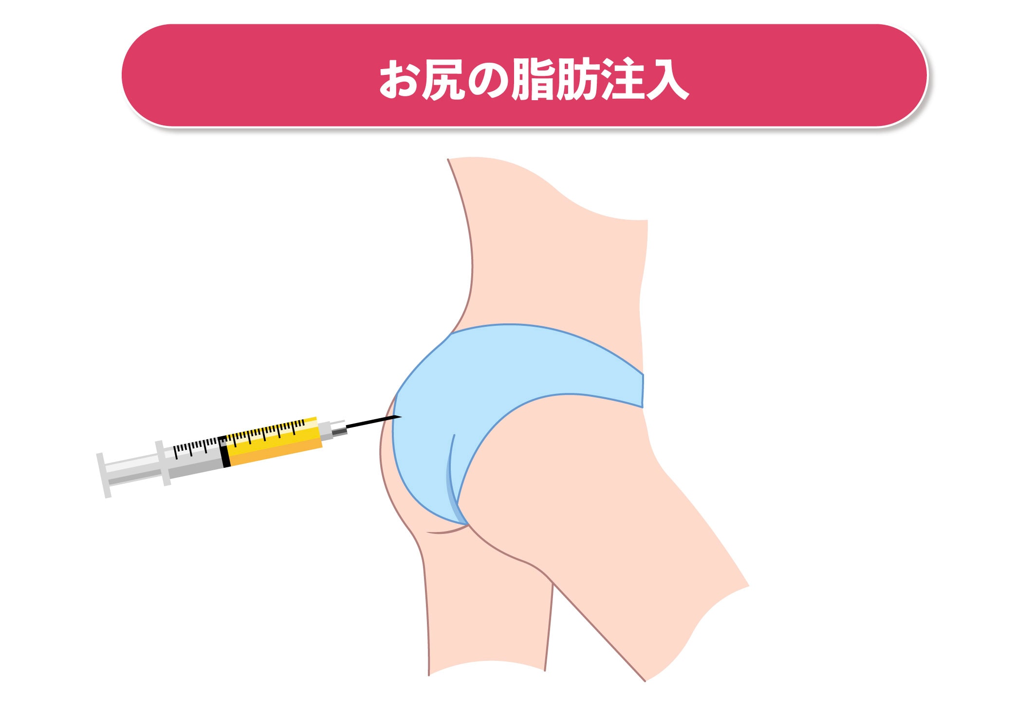 尻注射 