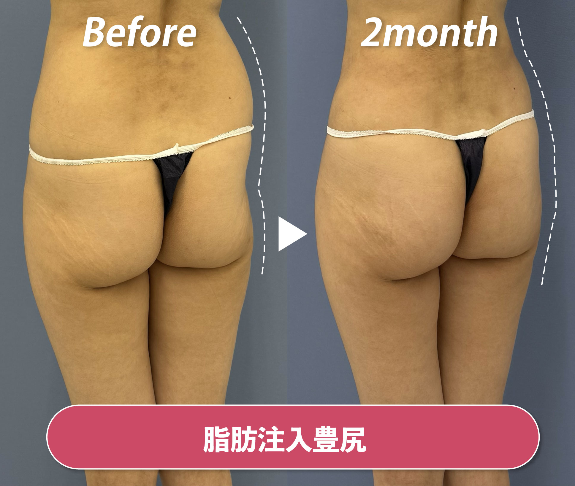 無修正 お尻パンティー 垂れ尻が治らない人必見！おしりの形を綺麗にする話題の豊尻手術について解説！ - 銀座院