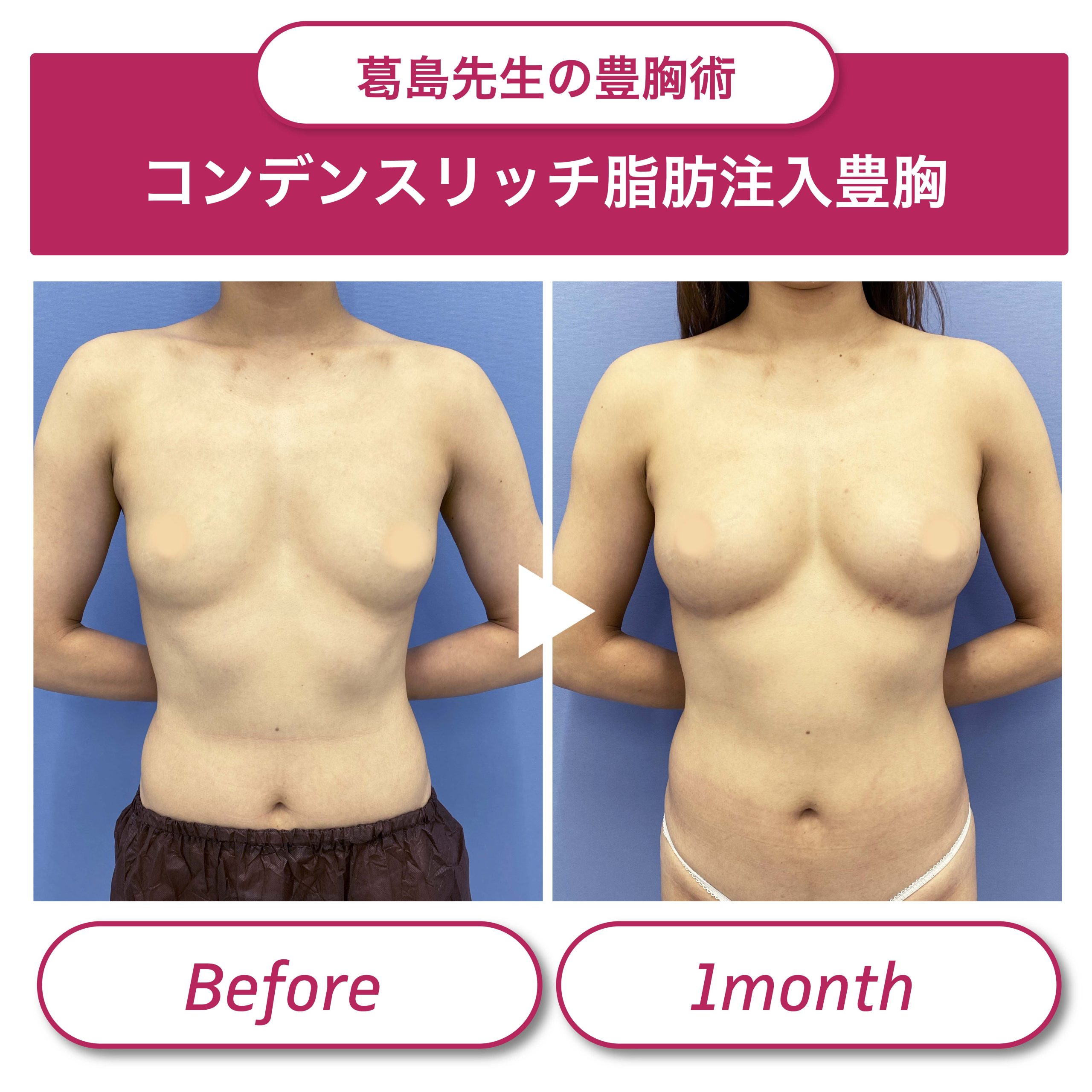 豊 胸 手術