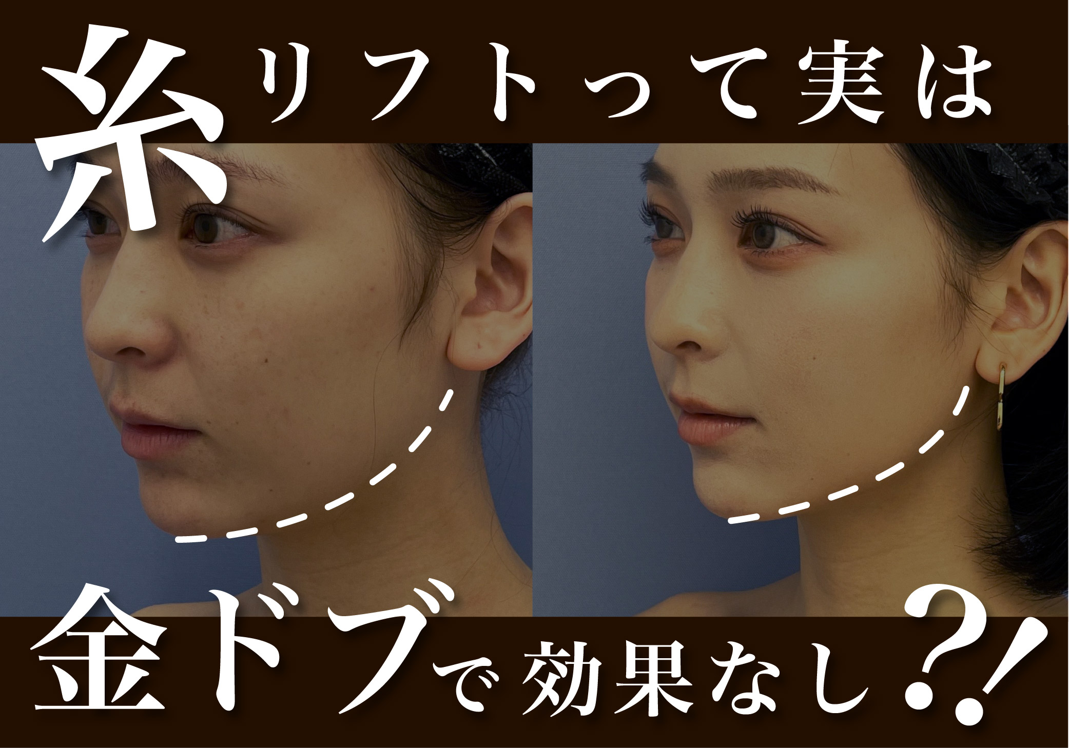 糸 リフト と は