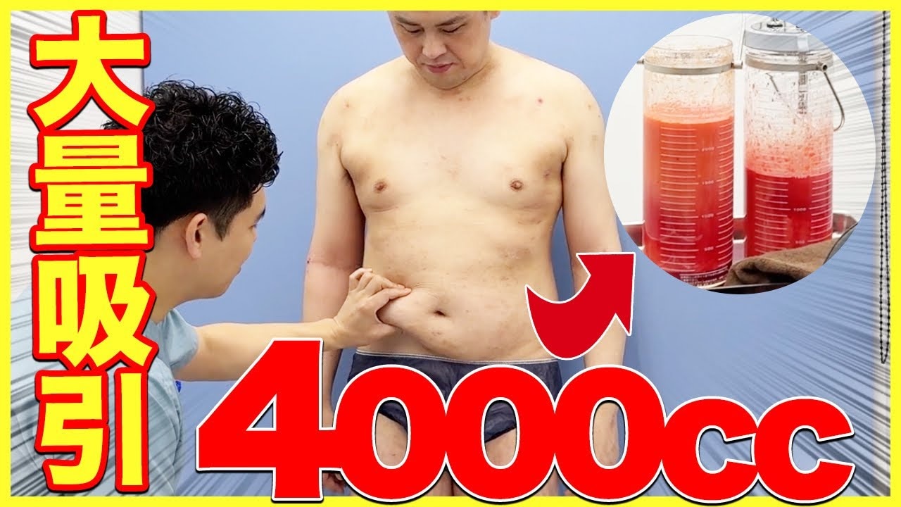 脂肪吸引一回で取れる量は？お腹やせを目指す男性の施術当日に密着！