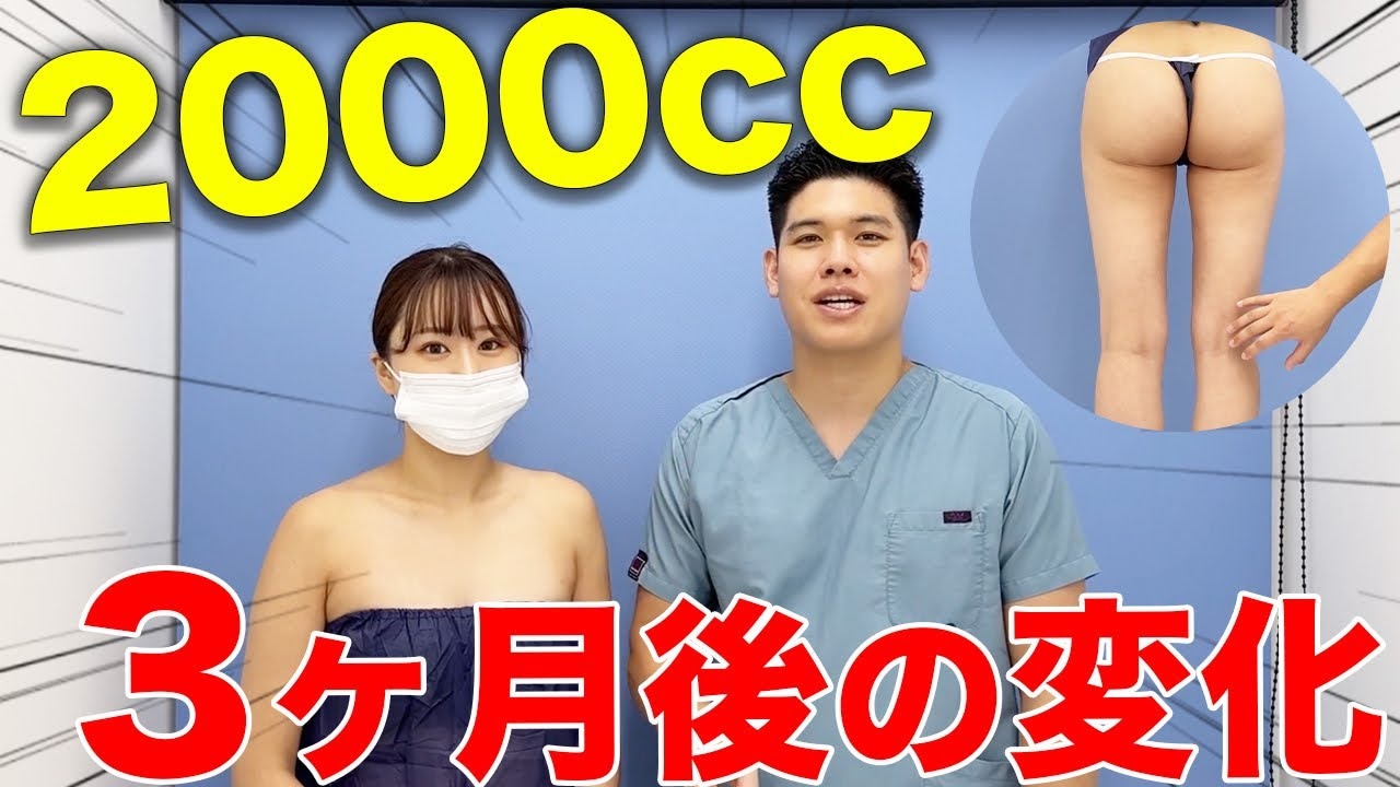 脂肪吸引後のむくみには漢方が効果的？ダウンタイム3ヶ月目の経過を紹介！