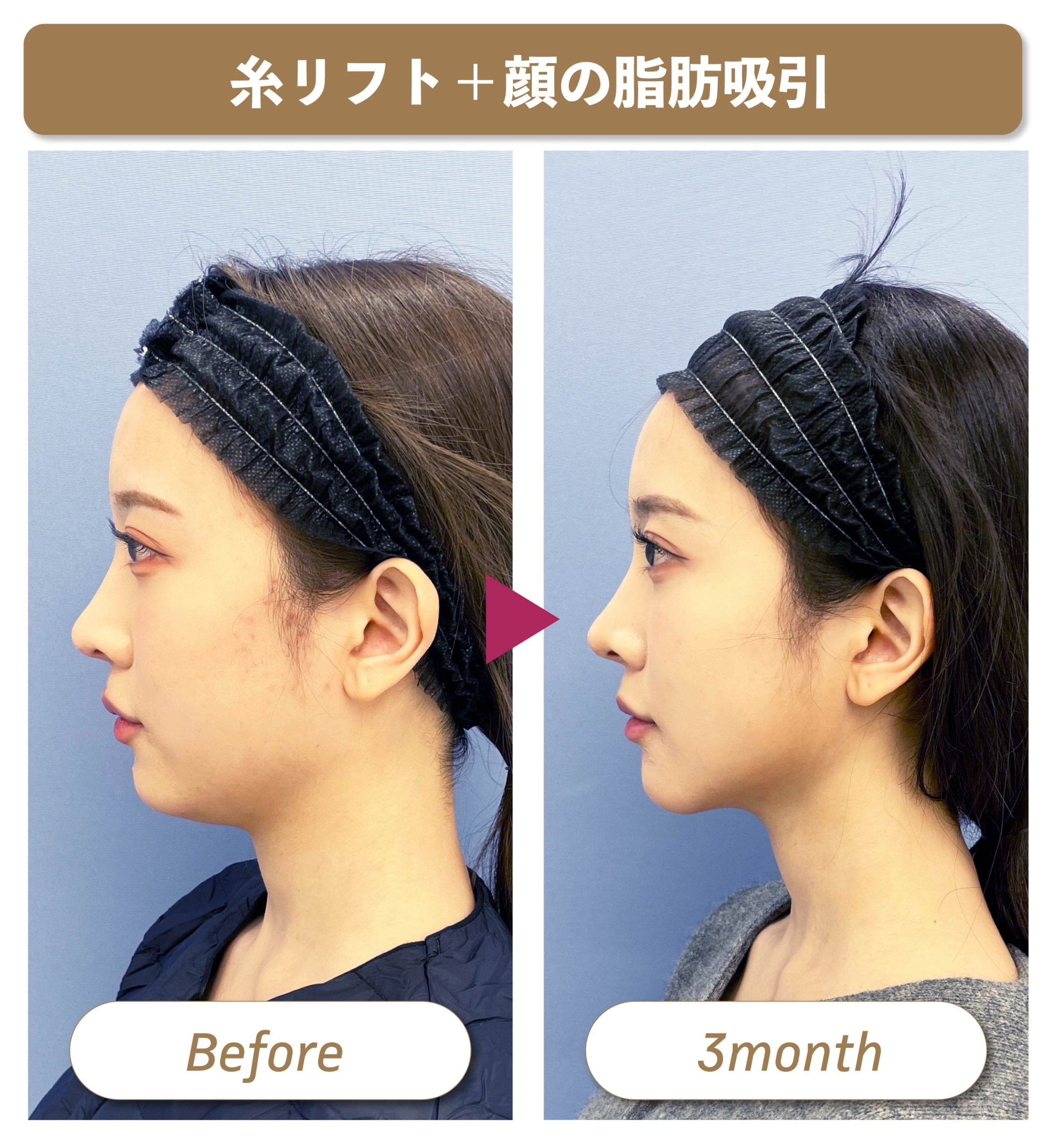 脂肪吸引と相性がいい