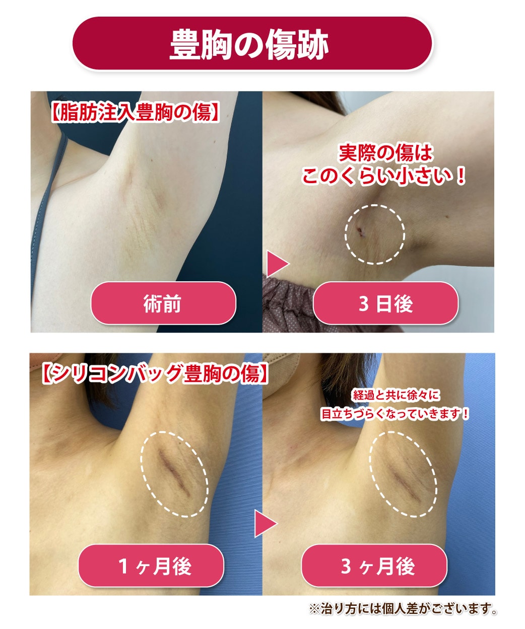 日本人 偽物豊胸おっぱい 豊胸おっぱいの見分け方！シリコンバッグや脂肪注入では見た目が違う？ - 銀座院