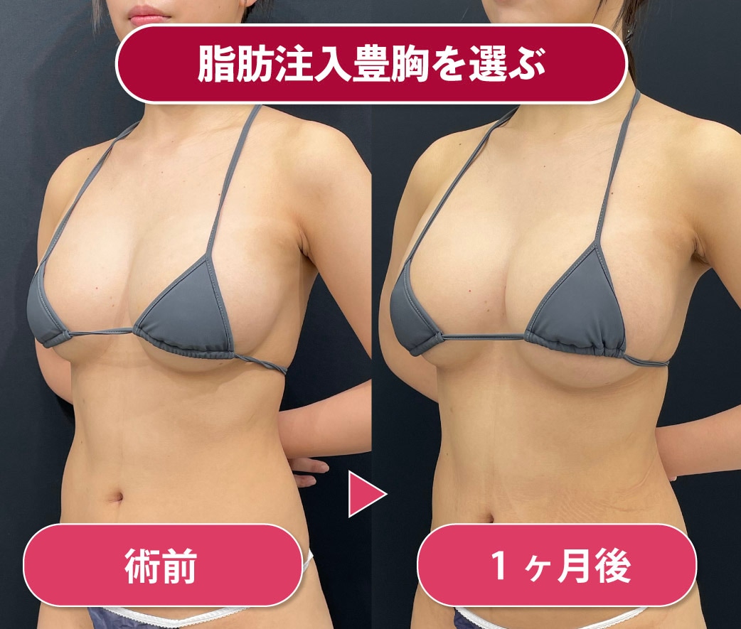 おっぱい比較 豊胸おっぱいの見分け方！シリコンバッグ豊胸や脂肪注入豊胸でバレない方法について豊胸の名医葛島先生が解説！ - 銀座院