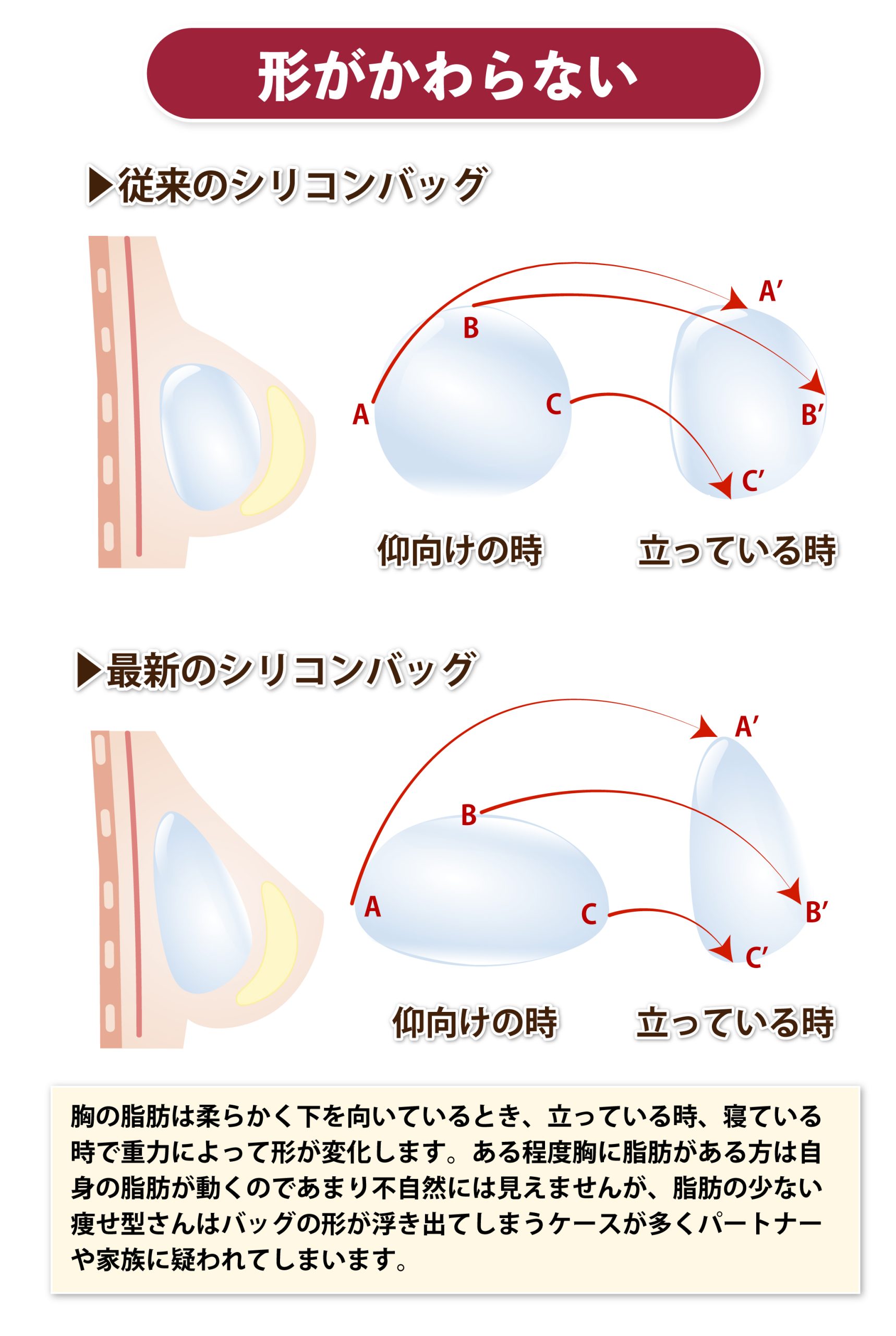 日本人 偽物豊胸おっぱい 
