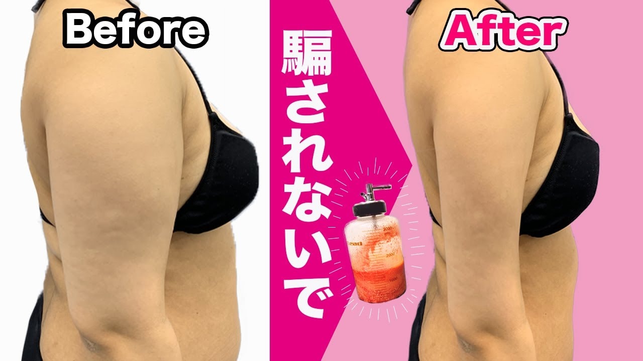 二の腕脂肪吸引の失敗を防ぐには？医師が教える症例写真の見極め方！