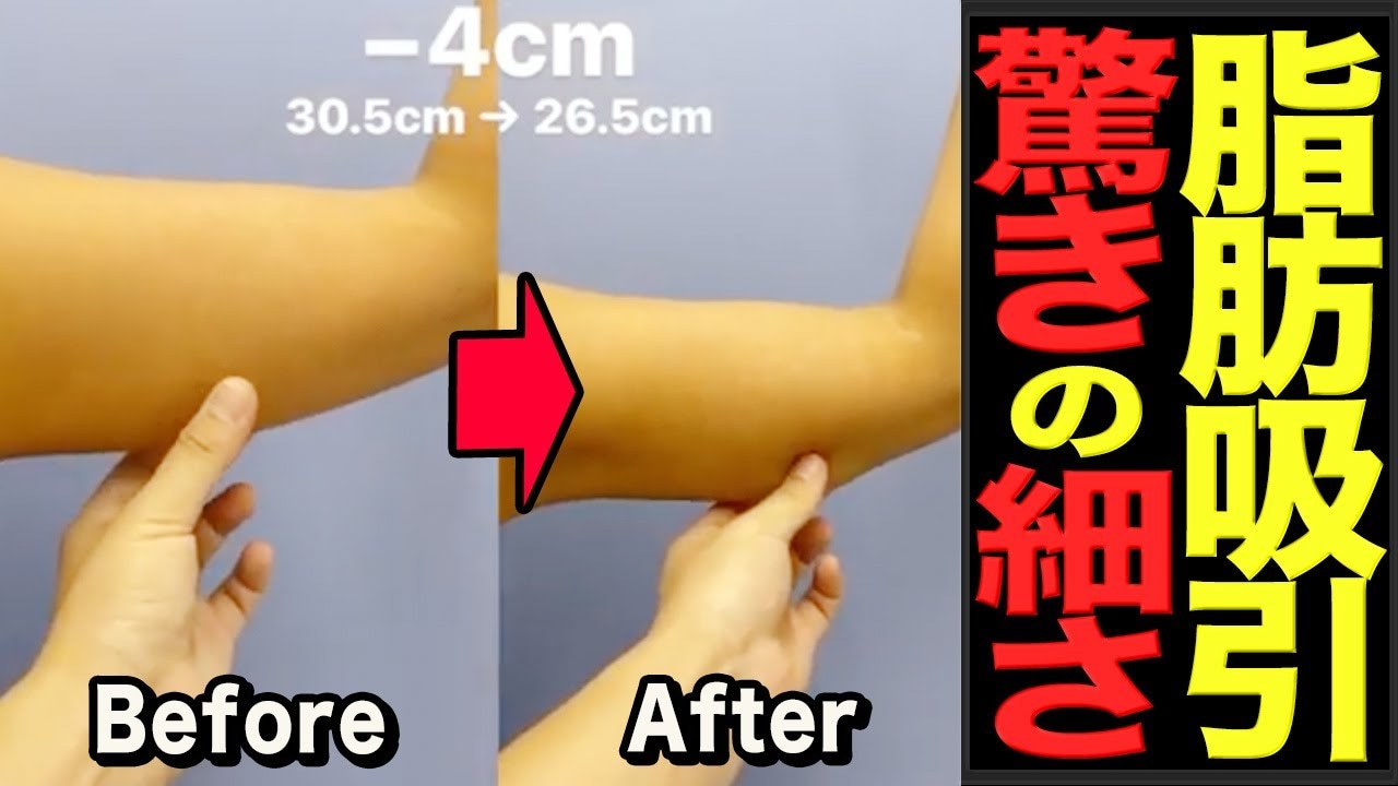 二の腕脂肪吸引で何センチ細くなる？女性トレーナーの経過3ヶ月目を直撃