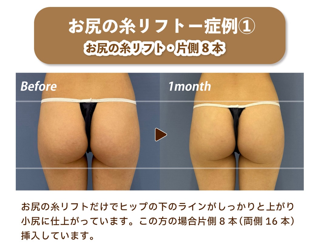 2017顔出しシミ付きパンツ 垂れ尻を解消！お尻の糸リフトが導入決定！究極のヒップアップ術最新治療バッドリフトが遂に銀座でも！ - 銀座院