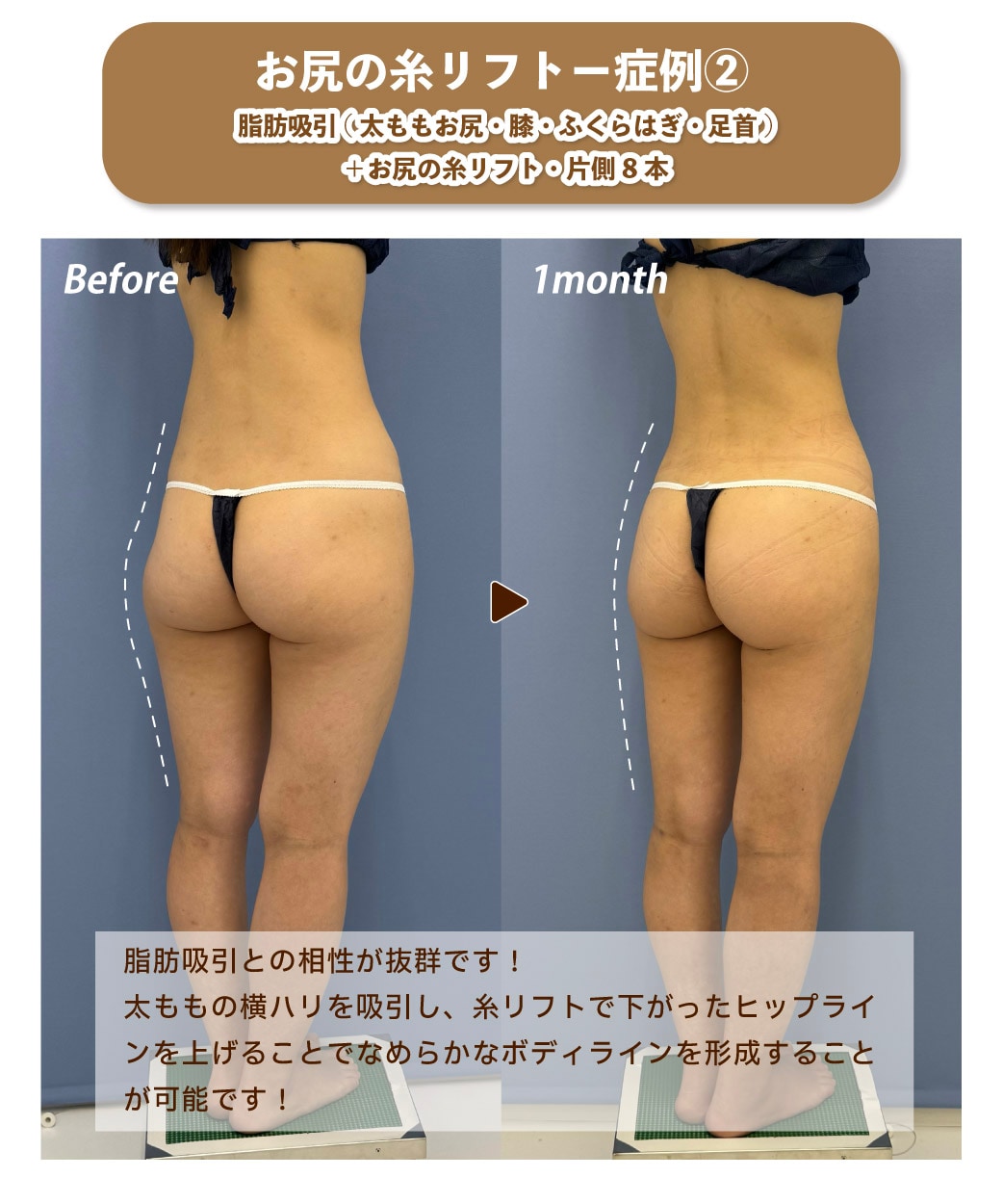 しり画像 垂れ尻を解消!お尻の糸リフトが導入決定!究極のヒップアップ術最新治療バッドリフトが遂に銀座でも! - 銀座院