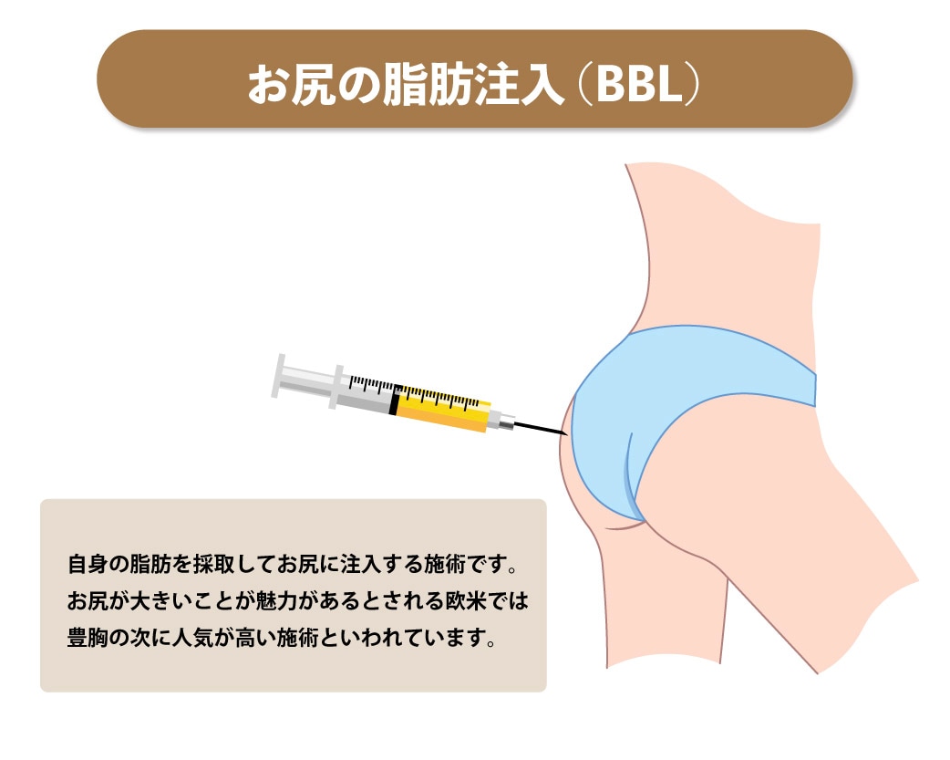 ２つ以上の尻 垂れ尻を解消！お尻の糸リフトが導入決定！究極のヒップアップ術最新治療バッドリフトが遂に銀座でも！ - 銀座院