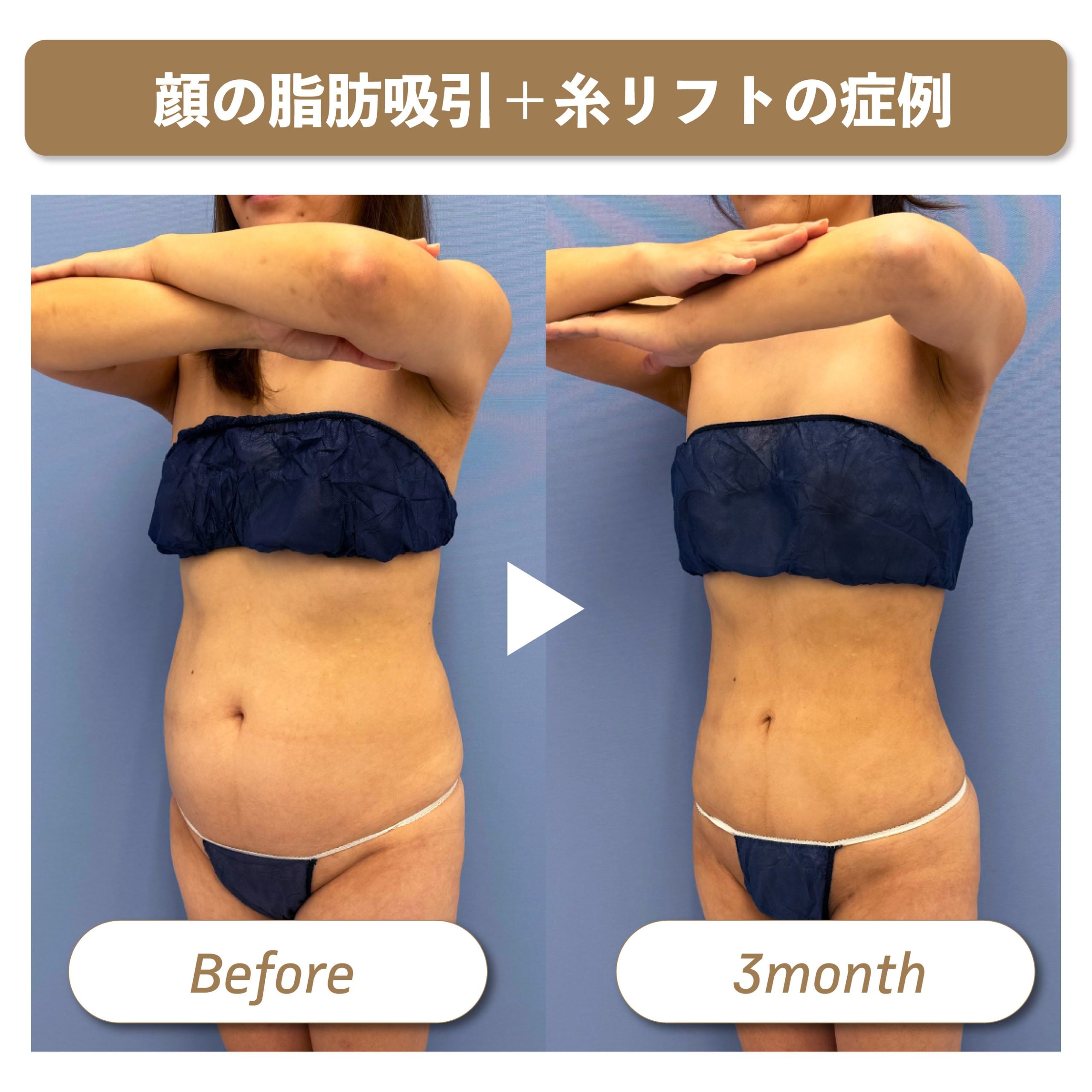 顔染みパンティ 脂肪吸引のダウンタイム「拘縮」はいつまで続く？早く治す方法3選！ - 銀座院