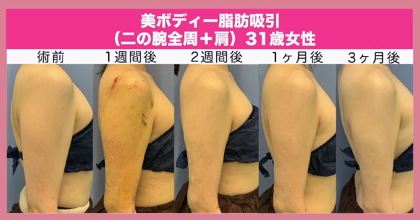 美ボディ脂肪吸引を徹底解説！二の腕の症例写真や施術の様子も紹介 