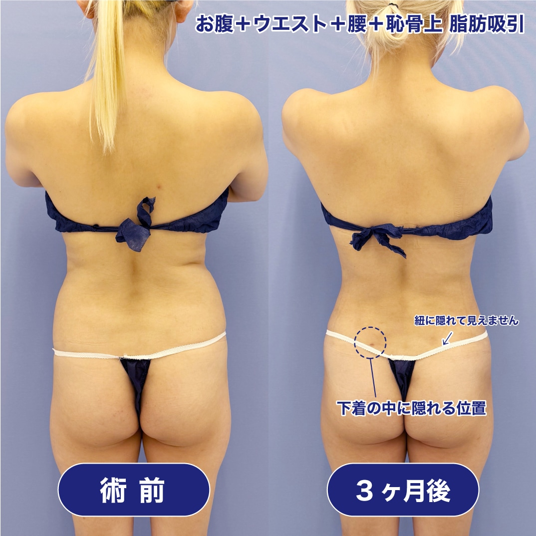 2017顔出しシミ付きパンツ 脂肪吸引の傷跡の位置について知っておくべきこととは？術後のケアについても解説！【徹底ガイド】 - 銀座院