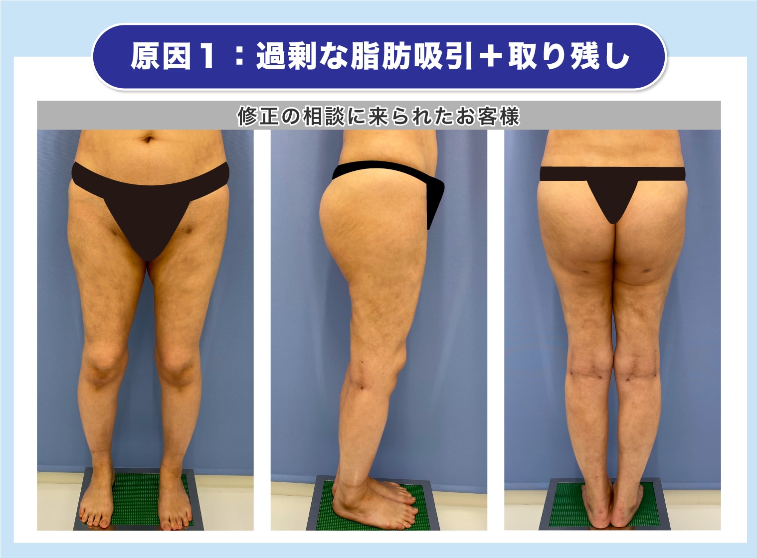 脂肪 吸引 失敗