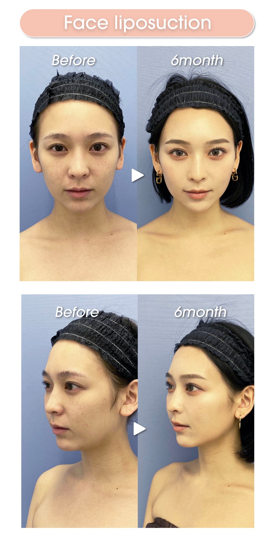 Facce liposuction