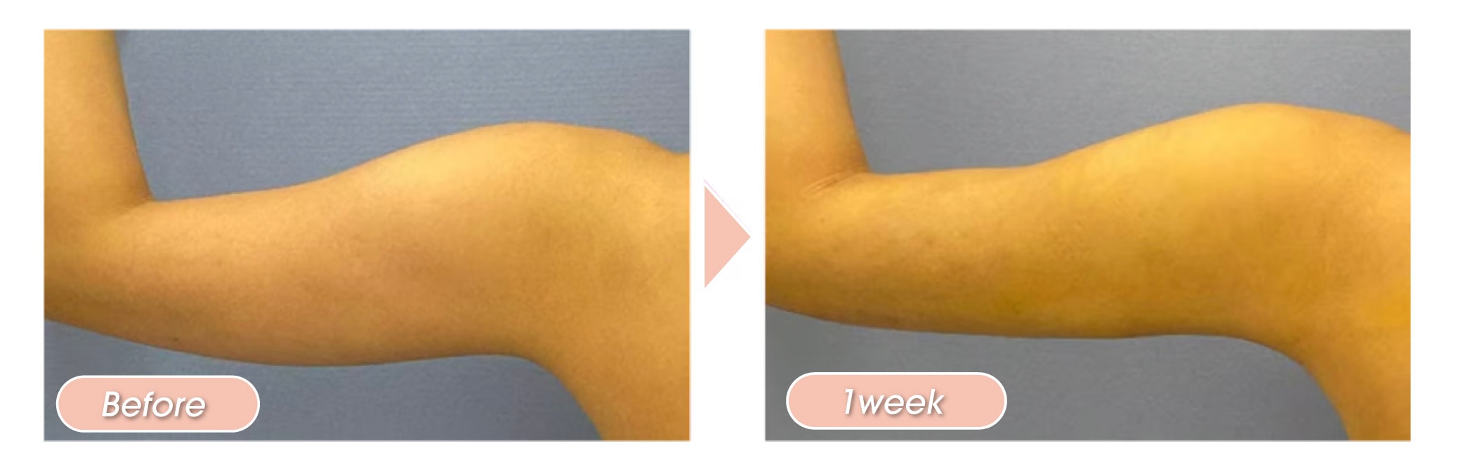 Adopts drainage method to minimize downtime after liposuction<br />