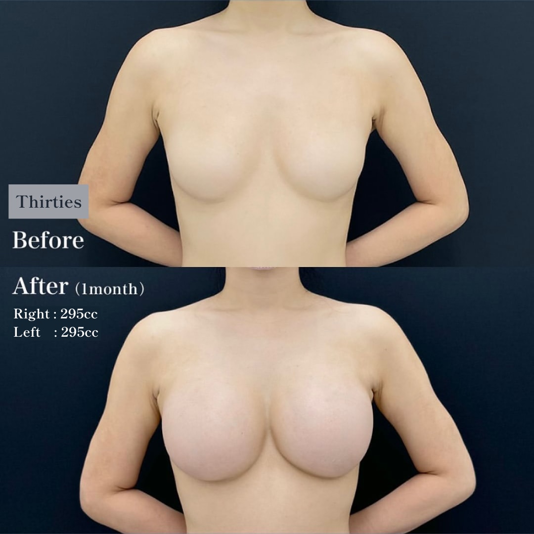 2.Silicone Breast Implants