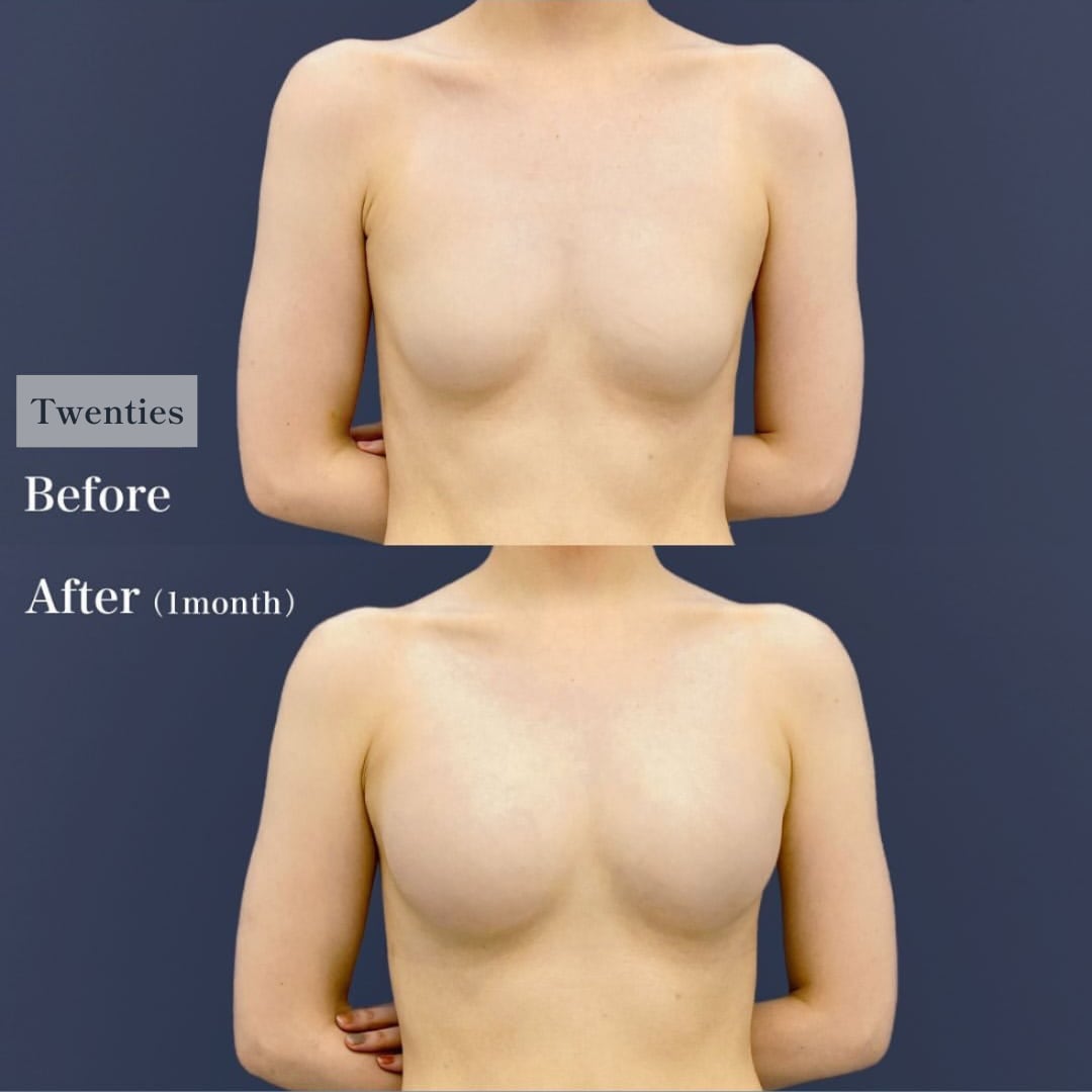 1.Fat Transfer Breast Augmentation