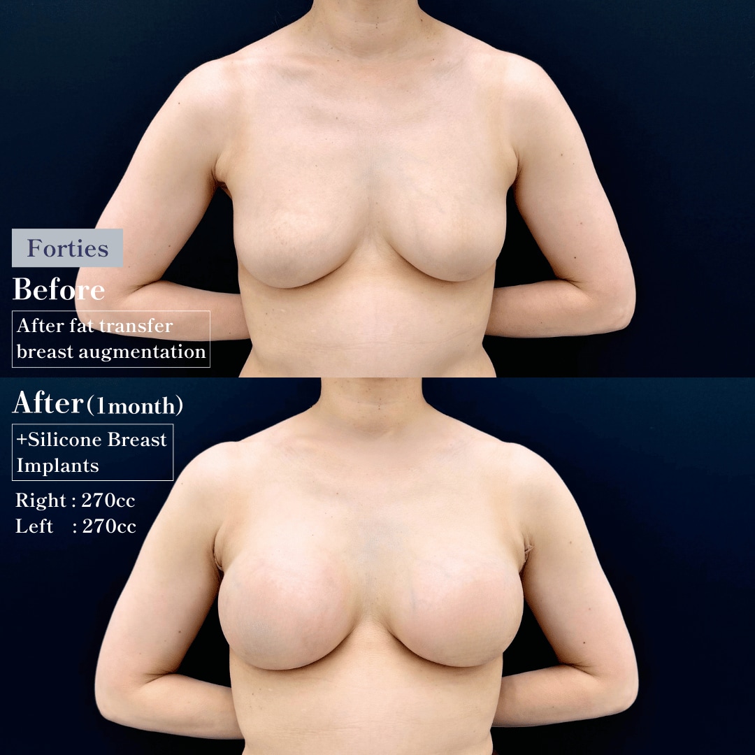 3.Hybrid Breast Augmentation