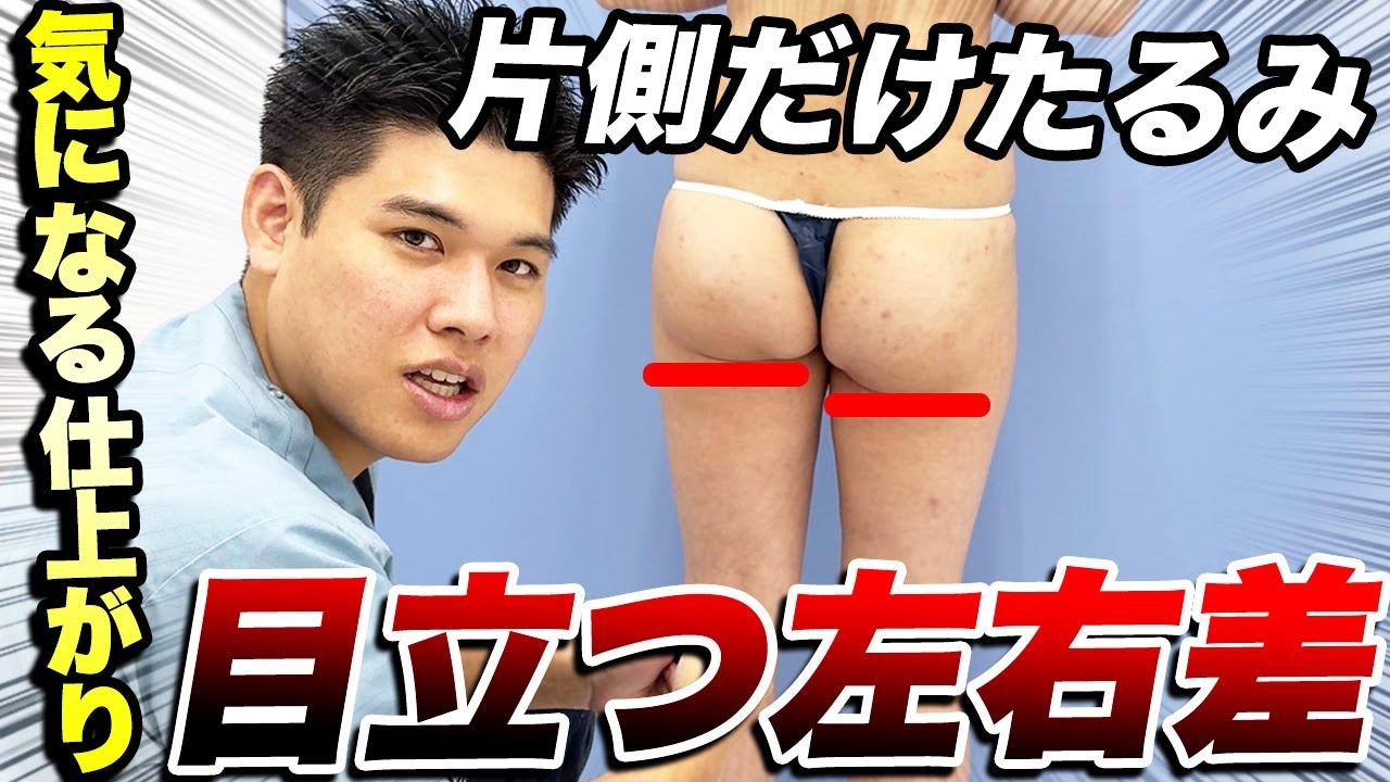 おしりが片方だけ大きいけど脂肪吸引するとどうなる？医師が解説