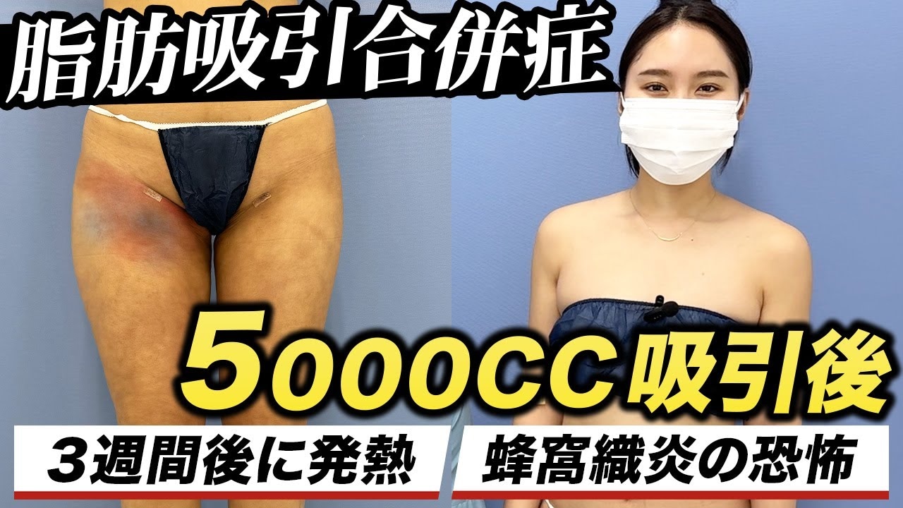 脂肪吸引後に蜂窩織炎になりやすい人の特徴とは？対処法も解説！