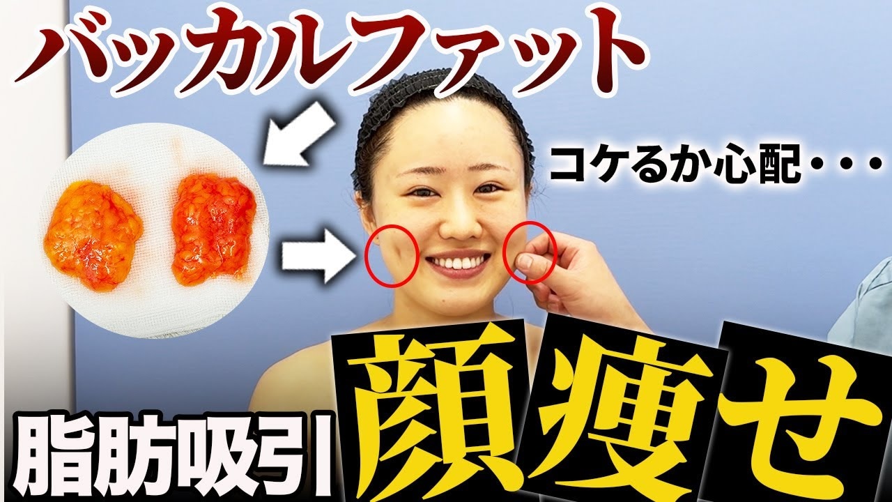 頬の内側を噛むのは太ったから？バッカルファットが向いている人の特徴
