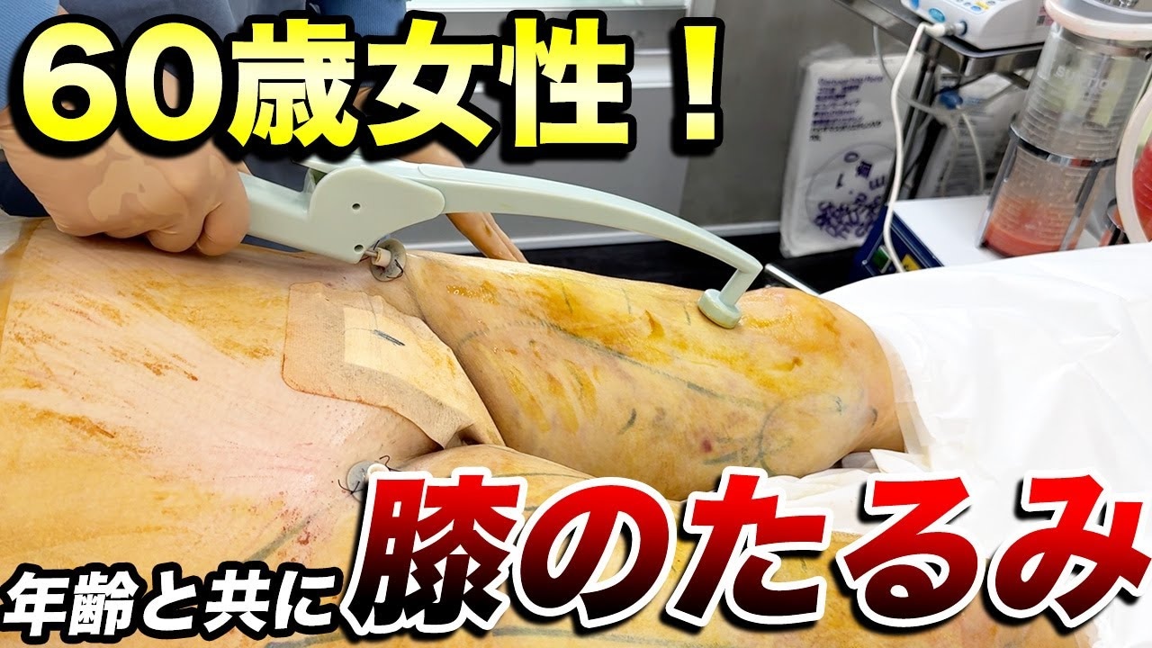 膝上のたるみを取る方法を医師が解説！すっきり引き締めたい方必見