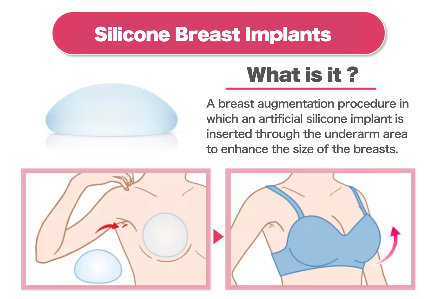 2.Silicone Breast Implants