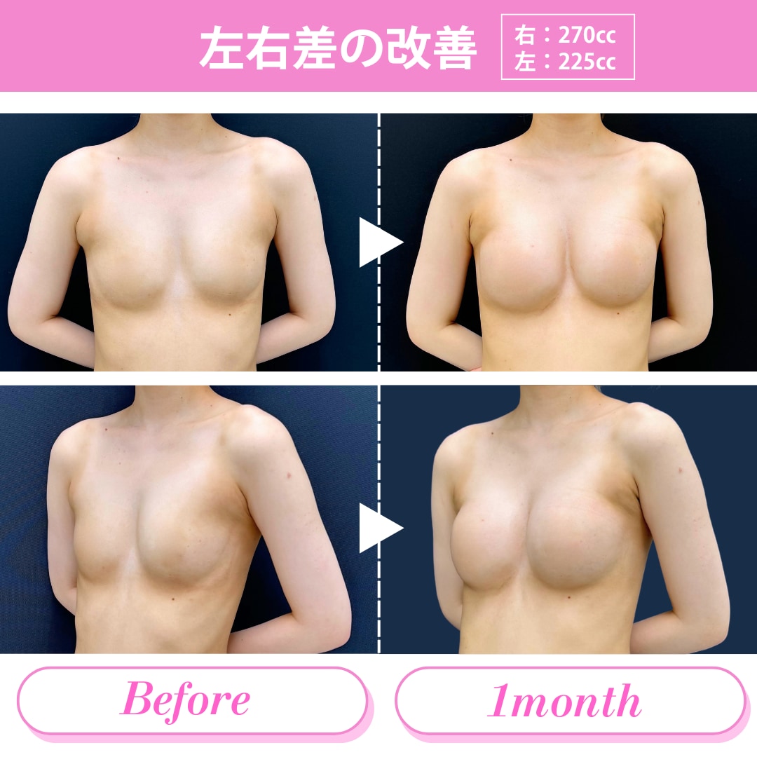 バストにお悩みがある方の症例