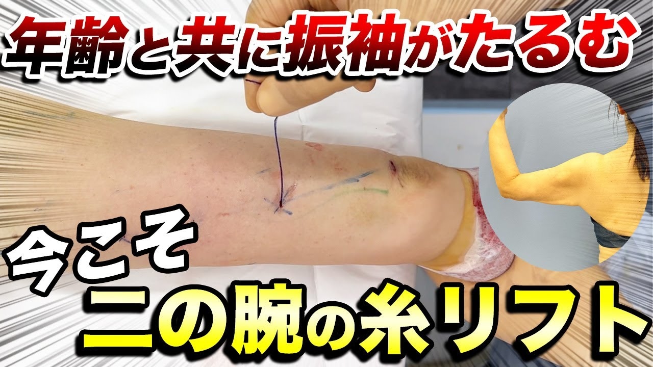二の腕のたるみが取れない人必見！糸リフトで解決してみませんか？