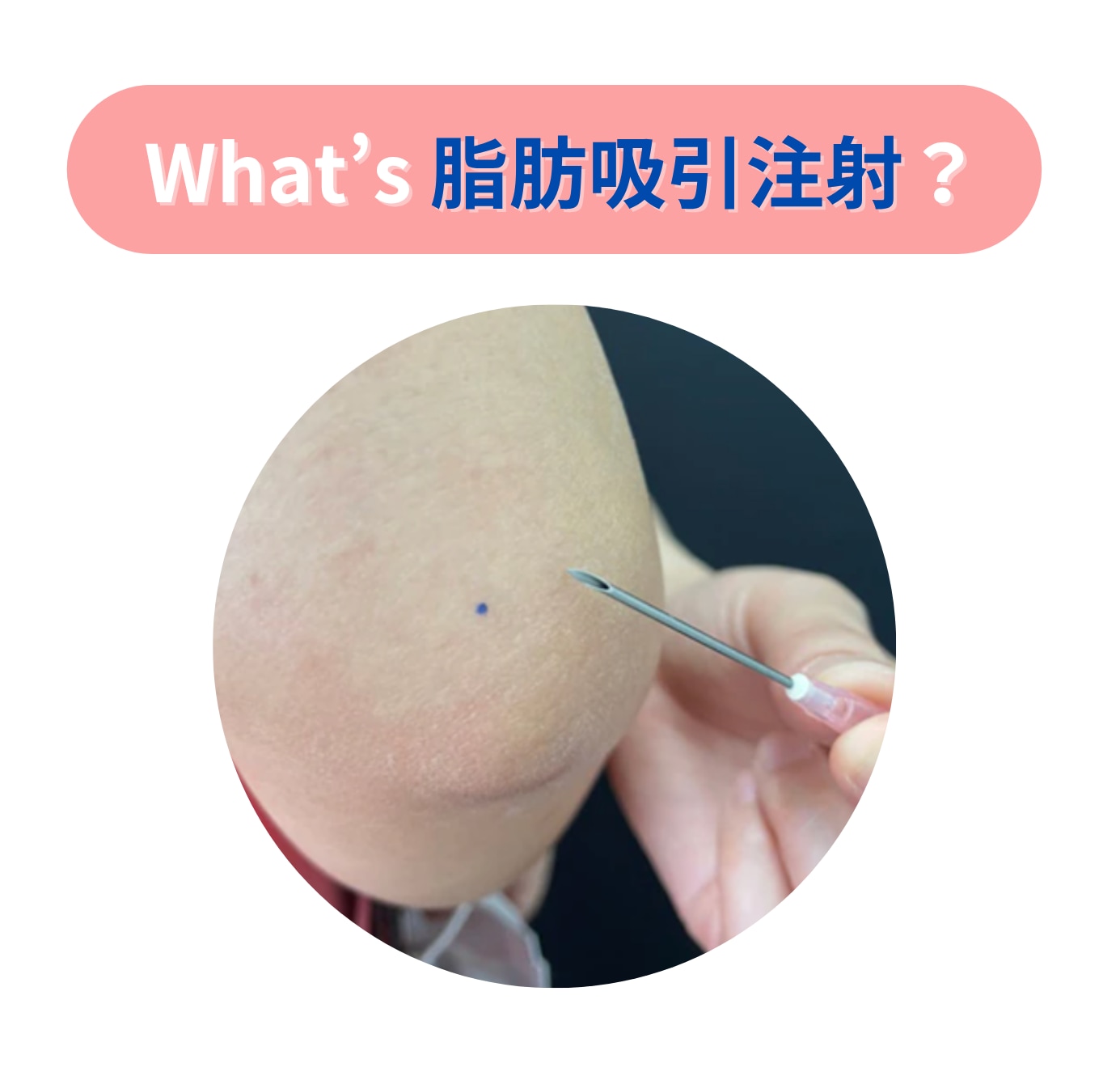脂肪吸引注射ってどんな施術?