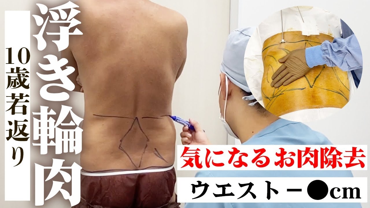 浮き輪肉を落とすのは難しい…男性のウエストと腰の脂肪吸引に密着！