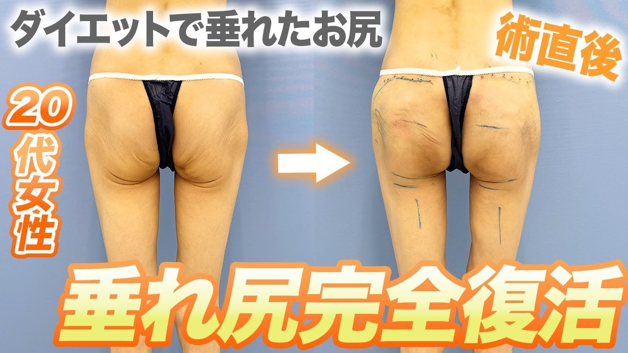 垂れ尻が治らない方必見！糸リフトとエンブレイスRFでどう変わる？